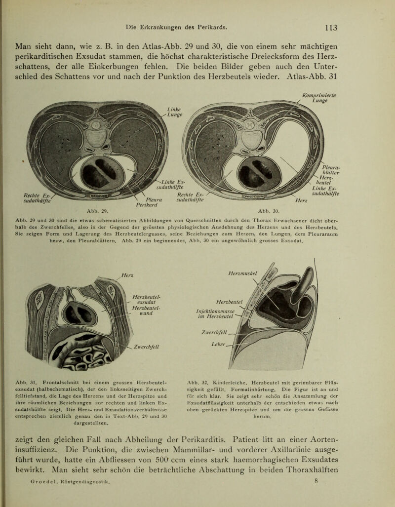 Man sieht dann, wie z. B. in den Atlas-Abb. 29 und 30, die von einem sehr mächtigen perikarditischen Exsudat stammen, die höchst charakteristische Dreiecksform des Herz- schattens, der alle Einkerbungen fehlen. Die beiden Bilder geben auch den Unter- schied des Schattens vor und nach der Punktion des Herzbeutels wieder. Atlas-Abb. 31 Linke Lunge Komprimierte Lunge Pleura Perikard Linke Ex- sudathälfte Rechte Ex- sudathälfte Pleura- blätter Herz- beutel Linke Ex- sudathälfte Herz Abb. 29. Abb. 30. Abb. 29 und 30 sind die etwas schematisierten Abbildungen von Querschnitten durch den Thorax Erwachsener dicht ober- halb des Zwerchfelles, also in der Gegend der grössten physiologischen Ausdehnung des Herzens und des Herzbeutels. Sie zeigen Form und Lagerung des Herzbeutelergusses, seine Beziehungen zum Herzen, den Lungen, dem Pleuraraum bezw. den Pleurablättern. Abb. 29 ein beginnendes, Abb. 30 ein ungewöhnlich grosses Exsudat. Herz Herzbeutel- exsudat Herzbeutel- wand Zwerchfell Herzmuskel Herzbeutel lnjekiionsmassc im Herzbeutel Zwerchfell Leber Abb. 31. Frontalschnitt bei einem grossen Herzbeutel- exsudat (halbschematisch), der den linksseitigen Zwerch- felltiefstand, die Lage des Herzens und der Herzspitze und ihre räumlichen Beziehungen zur rechten und linken Ex- sudatshälfte zeigt. Die Herz- und Exsudationsverhältnisse entsprechen ziemlich genau den in Text-Abb. 29 und 30 dargestellten. zeigt den gleichen Fall nach Abheilung der Perikarditis. Patient litt an einer Aorten- insuffizienz. Die Punktion, die zwischen Mammillar- und vorderer Axillarlinie ausge- führt wurde, hatte ein Abfliessen von 500 ccm eines stark haemorrhagischen Exsudates bewirkt. Man sieht sehr schön die beträchtliche Abschattung in beiden Thoraxhälften 8 Abb. 32. Kinderleiche. Herzbeutel mit gerinnbarer Flüs- sigkeit gefüllt. Formalinhärtung. Die Figur ist an und für sich klar. Sie zeigt sehr schön die Ansammlung der Exsudatflüssigkeit unterhalb der entschieden etwas nach oben gerückten Herzspitze und um die grossen Gefässe herum. Groedel, Röntgendiagnostik.