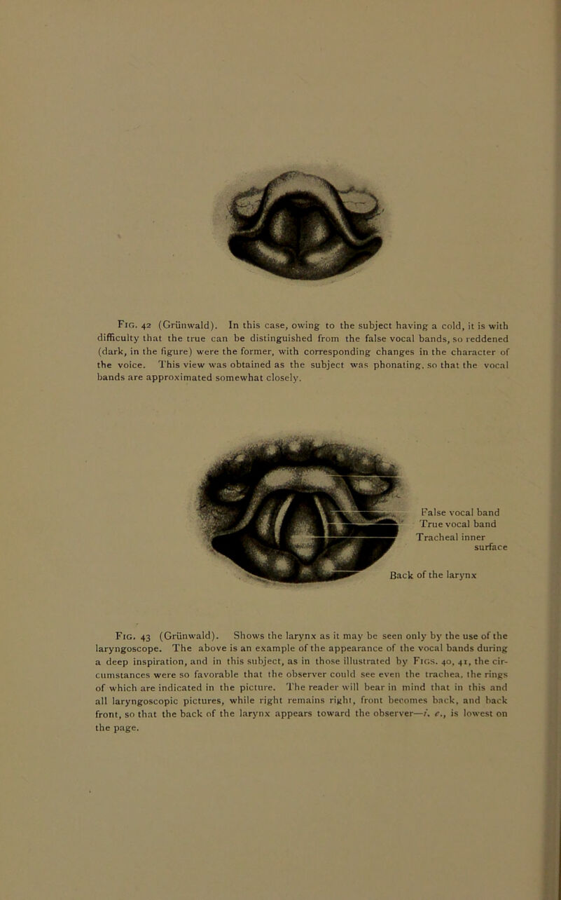 Fig. 42 (Grunwald). In this case, owing to the subject having a cold, it is with difficulty that the true can be distinguished from the false vocal bands, so reddened (dark, in the figure) were the former, with corresponding changes in the character of the voice. This view was obtained as the subject was phonating. so that the vocal bands are approximated somewhat closely. False vocal band True vocal band Tracheal inner surface of the larynx Fig. 43 (Grunwald). Shows the larynx as it may be seen only by the use of the laryngoscope. The above is an example of the appearance of the vocal bands during a deep inspiration, and in this subject, as in those illustrated by Figs. 40. 41, the cir- cumstances were so favorable that the observer could see even the trachea, the rings of which are indicated in the picture. The reader will bear in mind that in this and all laryngoscopic pictures, while right remains right, front becomes back, and back from, so that the back of the larynx appears toward the observer—1, c., is lowest on the page.