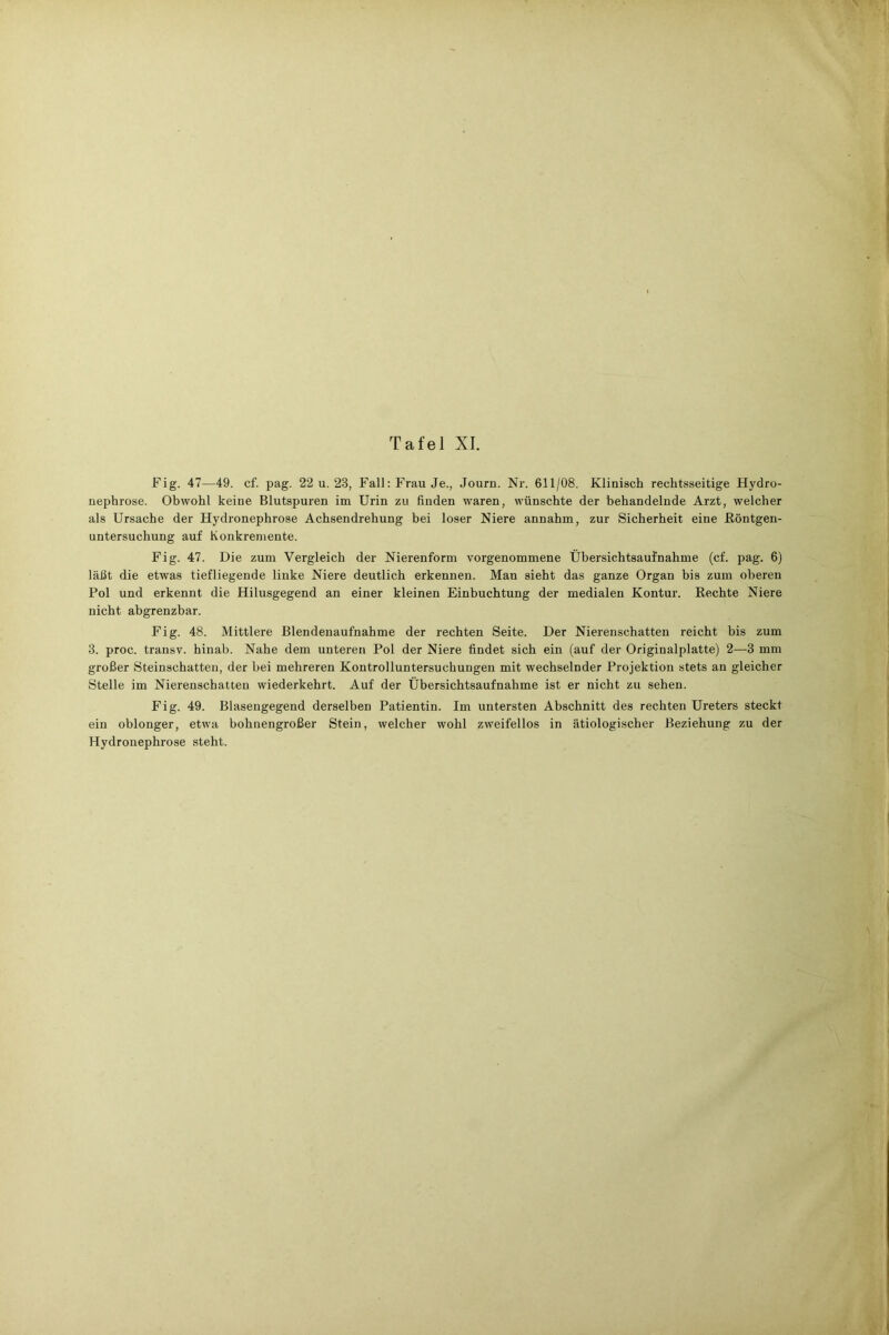 Fig. 47—49. cf. pag. 22 u. 28, Fall: Frau Je., Journ. Nr. 611/08. Klinisch rechtsseitige Hydro- nephrose. Obwohl keine Blutspuren im Urin zu finden waren, wünschte der behandelnde Arzt, welcher als Ursache der Hydronephrose Achsendrehung bei loser Niere annahm, zur Sicherheit eine Röntgen- untersuchung auf Konkremente. Fig. 47. Die zum Vergleich der Nierenform vorgenommene Übersichtsaufnahme (cf. pag. 6) läßt die etwas tiefliegende linke Niere deutlich erkennen. Man sieht das ganze Organ bis zum oberen Pol und erkennt die Hilusgegend an einer kleinen Einbuchtung der medialen Kontur. Rechte Niere nicht abgrenzbar. Fig. 48. Mittlere Blendenaufnahme der rechten Seite. Der Nierenschatten reicht bis zum 3. proc. transv. hinab. Nahe dem unteren Pol der Niere findet sich ein (auf der Originalplatte) 2—3 mm großer Steinschatten, der bei mehreren Kontrolluntersuchungen mit wechselnder Projektion stets an gleicher Stelle im Nierenschatten wiederkehrt. Auf der Übersichtsaufnahme ist er nicht zu sehen. Fig. 49. Blasengegend derselben Patientin. Im untersten Abschnitt des rechten Ureters steckt ein oblonger, etwa bohnengroßer Stein, welcher wohl zweifellos in ätiologischer Beziehung zu der Hydronephrose steht.