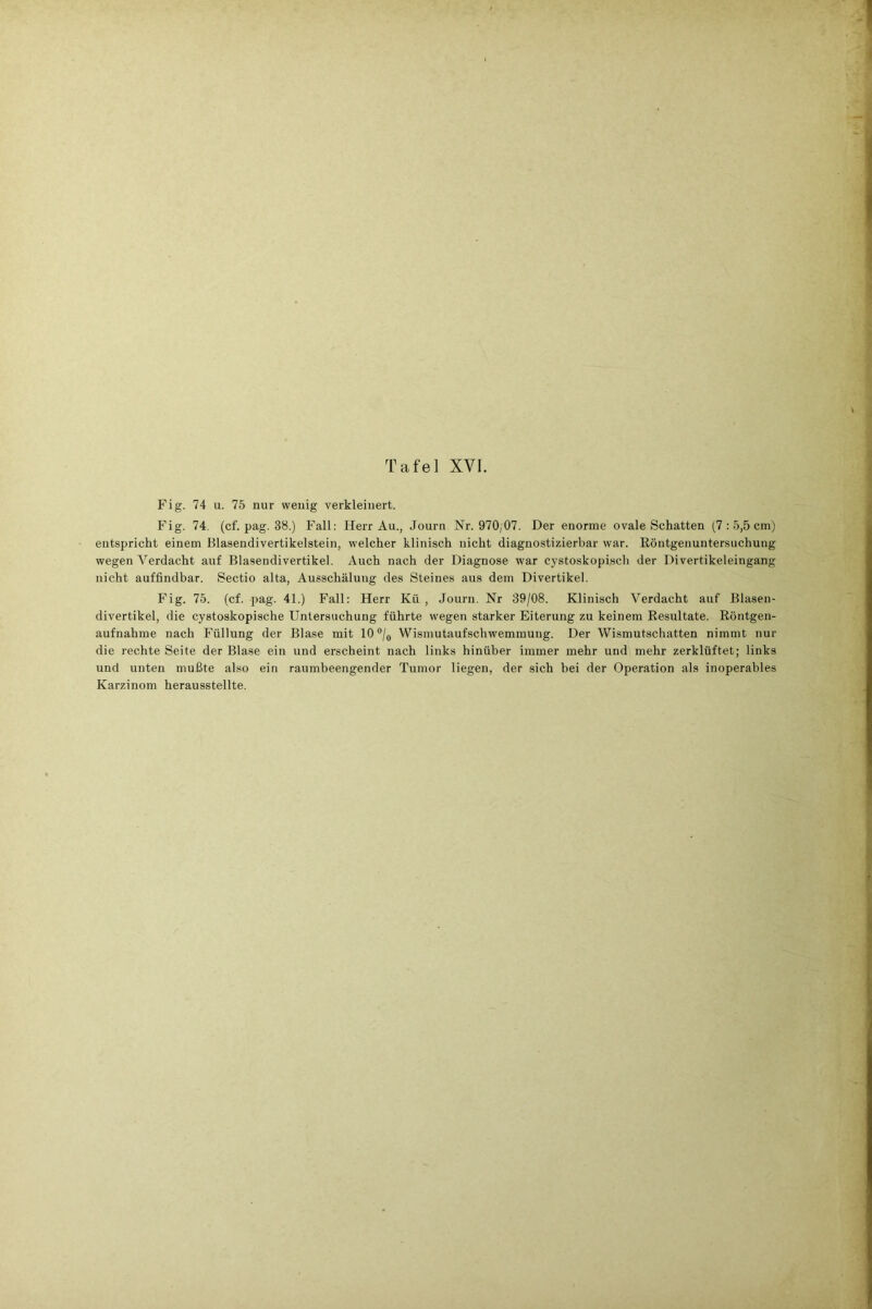 1 i Tafel XVI. Fig. 74 u. 75 nur wenig verkleinert. Fig. 74. (cf. pag. 38.) Fall: Herr Au., Journ Nr. 970/07. Der enorme ovale Schatten (7 : 5,5 cm) entspricht einem Blasendivertikelstein, welcher klinisch nicht diagnostizierbar war. Röntgenuntersuchung wegen Verdacht auf Blasendivertikel. Auch nach der Diagnose war cystoskopisch der Divertikeleingang nicht auffindbar. Sectio alta, Ausschälung des Steines aus dem Divertikel. Fig. 75. (cf. pag. 41.) Fall: Herr Kü , Journ. Nr 39/08. Klinisch Verdacht auf Blasen- divertikel, die cystoskopische Untersuchung führte wegen starker Eiterung zu keinem Resultate. Röntgen- aufnahme nach Füllung der Blase mit 10 °/0 Wismutaufschwemmung. Der Wismutschatten nimmt nur die rechte Seite der Blase ein und erscheint nach links hinüber immer mehr und mehr zerklüftet; links und unten mußte also ein raumbeengender Tumor liegen, der sich bei der Operation als inoperables Karzinom herausstellte.