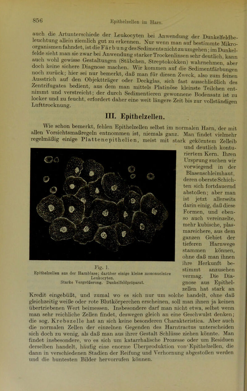 Epithelzellen im Harn. auch die Artunterschiede der Leukocyten bei Anwendung der Dunkelfeldbe- leuchtung allein ziemlich gut zu erkennen. Nur wenn man auf bestimmte Mikro- organismen fahndet, ist die Färb u ng des Sediments nicht zu umgehen • im Dunkel- felde sieht man sie zwar bei Anwendung starker Trockenlinsen sehr deutlich kann auch wohl gewisse Gestaltungen (Stäbchen, Streptokokken) wahrnehmen, aber doch keine sichere Diagnose machen. Wir kommen auf die Sedimentfärbungen noch zurück; hier sei nur bemerkt, daß man für diesen Zweck, also zum feinen Ausstrich auf den Objektträger oder Deckglas, sich fast ausschließlich des Zentnfugates bedient, aus dem man mittels Platinöse kleinste Teilchen ent- nimmt und verstreicht; der durch Sedimentieren gewonnene Bodensatz ist zu locker und zu feucht, erfordert daher eine weit längere Zeit bis zur vollständigen Lufttrocknung. III. Epithelzellen. Wie schon bemerkt, fehlen Epithelzellen selbst im normalen Harn, der mit allen Vorsichtsmaßregeln entnommen ist, niemals ganz. Man findet vielmehr regelmäßig einige Plattenepithelien, meist mit stark gekörntem Zelleib und deutlich kontu- riertem Kern. Ihren Ursprung suchen wir vorwiegend in der Blasenschleimhaut, deren oberste Schich- ten sich fortdauernd abstoßen; aber man ist jetzt allerseits darin einig, daß diese Formen, und eben- so auch vereinzelte, mehr kubische, plas- mareichere, aus dem ganzen Gebiet der tieferen Harnwege stammen können, ohne daß man ihnen ihre Herkunft be- stimmt anzusehen vermag. Die Dia- gnose aus Epithel- zellen hat stark an Kredit eingebüßt, und zumal wo es sich nur um solche handelt, ohne daß gleichzeitig weiße oder rote Blutkörperchen erscheinen, soll man ihnen ja keinen übertriebenen Wert beimessen. Insbesondere darf man nicht etwa, selbst wenn man sehr reichliche Zellen findet, deswegen gleich an eine Geschwulst denken; die sog. Krebszelle hat an sich keine besonderen Charakteristica. Aber auch die normalen Zellen der einzelnen Gegenden des Harntractus unterscheiden sich doch zu wenig, als daß man aus ihrer Gestalt Schlüsse ziehen könnte. Man findet insbesondere, wo es sich um katarrhalische Prozesse oder um Residuen derselben handelt, häufig eine enorme Überproduktion von' Epithelzellen, die dann in verschiedenen Stadien der Reifung und Verhornung abgestoßen werden und die buntesten Bilder hervorrufen können. Fi g- 1. Epithelzellen aus der Harnblase; darüber einige kleine mononucleäre Leukocyten. Starke Vergrößerung. Dunkelfeldpräparat.