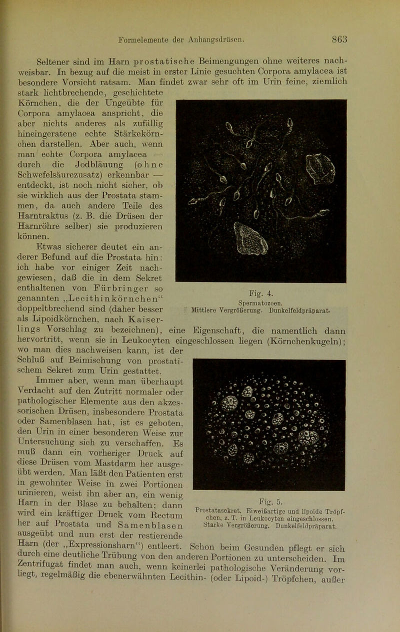 Seltener sind im Harn prostatische Beimengungen ohne weiteres nach- weisbar. In bezug auf die meist in erster Linie gesuchten Corpora amylacea ist besondere Vorsicht ratsam. Man findet zwar sehr oft im Urin feine, ziemlich stark lichtbrechende, geschichtete Körnchen, die der Ungeübte für Corpora amylacea anspricht, die aber nichts anderes als zufällig hineingeratene echte Stärkekörn- chen darstellen. Aber auch, wenn man echte Corpora amylacea — durch die Jodbläuung (o h n e Schwefelsäurezusatz) erkennbar — entdeckt, ist noch nicht sicher, ob sie wirklich aus der Prostata stam- men, da auch andere Teile des Harntraktus (z. B. die Drüsen der Harnröhre selber) sie produzieren können. Etwas sicherer deutet ein an- derer Befund auf die Prostata Inn: ich habe vor einiger Zeit nach- gewiesen, daß die in dem Sekret enthaltenen von Fürbringer so genannten „Lecithinkörnchen“ doppeltbrechend sind (daher besser f’ ' . . . F T ^ X * ö . ’M ■ I ' ^a y - ' i J ') •. r . .,-c~ . Fig. 4. Spermatozoen. Mittlere Vergrößerung. Dunkelfeldpräparat. als Lipoidkörnchen, nach Kaiser- lings Vorschlag zu bezeichnen), eine Eigenschaft, die namentlich dann hervortritt, wenn sie in Leukocyten eingeschlossen hegen (Körnchenkugeln); wo man dies nachweisen kann, ist der Schluß auf Beimischung von prostati- schem Sekret zum Urin gestattet. Immer aber, wenn man überhaupt Verdacht auf den Zutritt normaler oder pathologischer Elemente aus den akzes- sorischen Drüsen, insbesondere Prostata oder Samenblasen hat, ist es geboten, den Urin in einer besonderen Weise zur Untersuchung sich zu verschaffen. Es muß dann ein vorheriger Druck auf diese Drüsen vom Mastdarm her ausge- übt werden. Man läßt den Patienten erst in gewohnter Weise in zwei Portionen urinieren, weist ihn aber an, ein wenig Harn in der Blase zu behalten; dann wird ein kräftiger Druck vom Rectum her auf Prostata und Samenblasen ausgeübt und nun erst der Testierende Harn (der „Expressionsharn“) entleert. Schon beim Gesunden pflegt er sich durch eine deutliche Trübung von den anderen Portionen zu unterscheiden. Im fentnlugat findet man auch, wenn keinerlei pathologische Veränderung vor- üegt, regelmäßig die ebenerwähnten Lecithin- (oder Lipoid-) Tröpfchen, außer ° ^nSjr,* * o o - .r. <*' .• ■ • ViS « - /\v fl#*. -'-**'« *?■ & -‘o’ Fig. 5. Prostatasekret. Eiweißartigo und lipoide Tröpf- chen, z. T. in Leukocyten eingeschlossen. Starke Vergrößerung. Dunkelfeldpräparat.
