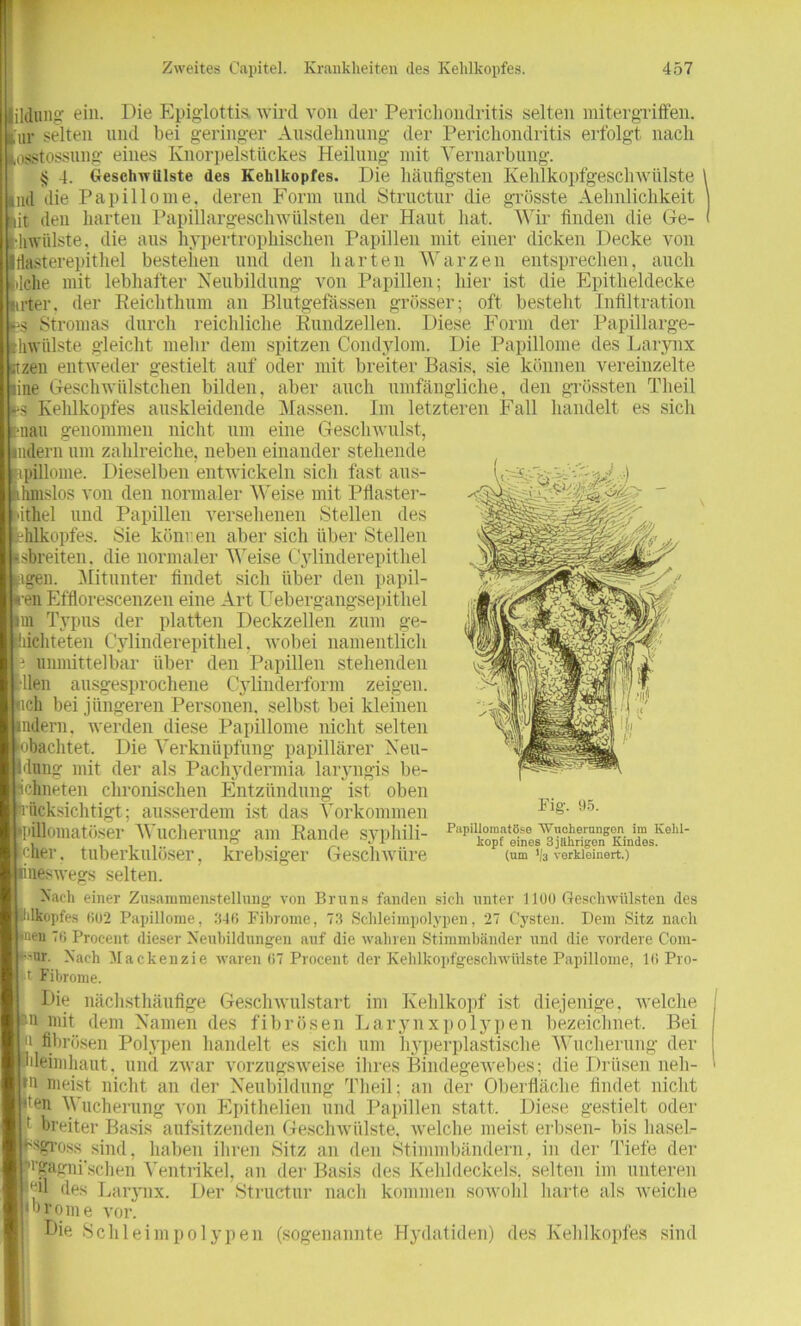 Die Epiglottis, wird von der Perichondritis selten mitergriffen. erfolgt nach ildung ein. ur selten und bei geringer Ausdehnung der Perichondritis osstossnng eines Knorpelstückes Heilung mit Vernarbung. $ 4. Geschwülste des Kehlkopfes. Die häufigsten IvehlkopfgeschWülste ml die Papillome, deren Form und Structur die grösste Aelmlichkeit it den harten Papillargeschwülsten der Haut hat. Wir finden die Ge- liwiilste. die aus hypertrophischen Papillen mit einer dicken Decke von flasterepithel bestehen und den harten Warzen entsprechen, auch lclie mit lebhafter Neubildung von Papillen; hier ist die Epitheldecke irter. der Reichthum an Blutgefässen grösser; oft besteht Infiltration Stromas durch reichliche Rundzellen. Diese Form der Papillarge- hwiilste gleicht mehr dem spitzen Condylom. Die Papillome des Larynx zen entweder gestielt auf oder mit breiter Basis, sie können vereinzelte ine Geschwiilstchen bilden, aber auch umfängliche, den grössten Tlieil s Kehlkopfes auskleidende Massen. Im letzteren Fall handelt es sich nau genommen nicht um eine Geschwulst, ndern um zahlreiche, neben einander stehende pillome. Dieselben entwickeln sich fast aus- hmslos von den normaler Weise mit Pflaster- ithel und Papillen versehenen Stellen des hlkopfes. Sie können aber sich über Stellen sbreiten. die normaler Weise Cylinderepithel igen. Mitunter findet sich über den papil- •en Efflorescenzen eine Art Uebergangsepithel in Typus der platten Deckzellen zum ge- lichteten Cylinderepithel. wobei namentlich unmittelbar über den Papillen stehenden llen ausgesprochene Cylinderform zeigen, uch bei jüngeren Personen, selbst bei kleinen ndern, werden diese Papillome nicht selten bachtet. Die Verknüpfung papillärer Neu- dnng mit der als Pachydennia laryngis be- chneten chronischen Entzündung ist oben ncksichtigt; ausserdem ist das Vorkommen jpillomatöser Wucherung am Rande syphili- cher. tuberkulöser, krebsiger Geschwüre neswegs selten. Nach einer Zusammenstellung- von Bruns fanden sieh unter 1100 Geschwülsten des dkopfes 602 Papillome, 346 Fibrome, 73 Schleimpolypen, 27 Cysten. Dem Sitz nach en 76 Procent dieser Neubildungen auf die wahren Stimmbänder und die vordere Com- or. Nach Mackenzie w-aren 67 Procent der Kehlkopfgeschwülste Papillome, 16 Pro- Fibrome. Die nächsthäufige Geschwulstart im Kehlkopf ist diejenige, welche n mit dem Namen des fibrösen Larynxpolypen bezeichnet. Bei fibrösen Polypen handelt es sich um hyperplastische Wucherung der deimhaut, und zwar vorzugsweise ihres Bindegewebes; die Drüsen neh- 111 meist nicht an der Neubildung Tlieil; an der Oberfläche findet nicht ^en Wucherung von Epithelien und Papillen statt. Diese gestielt oder Fig. 95. Papillomatöse Wucherungen im Kehl- kopf eines 3 jährigen Kindes. (um 1/3 verkleinert.) breiter Basis aufsitzenden Geschwülste, welche meist erbsen- bis luisel- s?ross sind, haben ihren Sitz an den Stimmbändern, in der Tiefe der ’gagni’schen Ventrikel, an der Basis des Kehldeckels, selten im unteren ml des Larynx. Der Structur nach kommen sowohl harte als weiche orome vor. Die Schleimpolypen (sogenannte Hydatiden) des Kehlkopfes sind