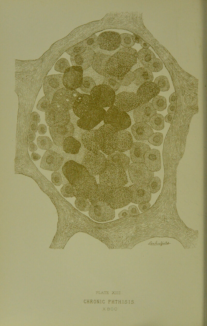 PLATE XIII CHRONIC PHTHISIS X 800