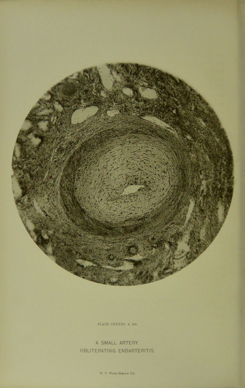 PLATE (J X X X111. x Kill. A SMALL ARTERY. OBLITERATING ENDARTERITIS.