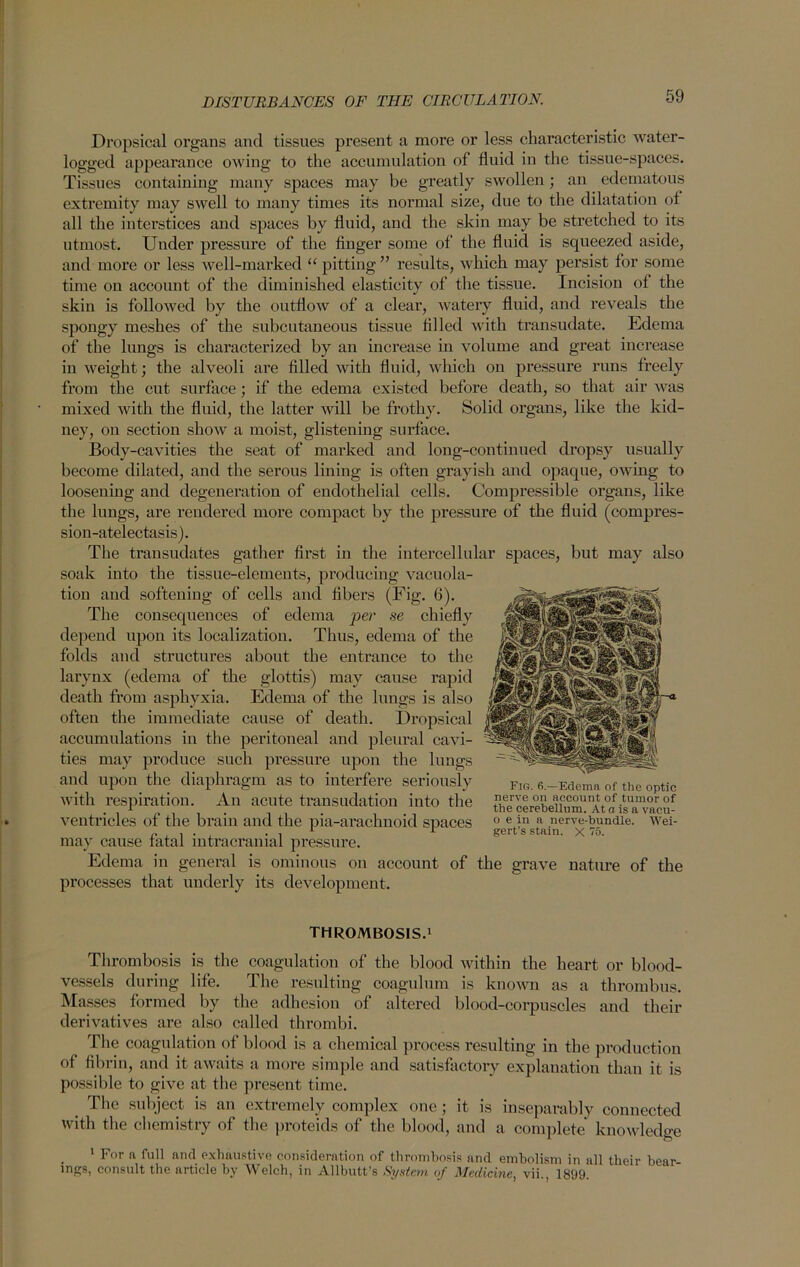 Dropsical organs and tissues present a more or less characteristic water- logged appearance owing to the accumulation of fluid in the tissue-spaces. Tissues containing many spaces may be greatly swollen; an edematous extremity may swell to many times its normal size, due to the dilatation of all the interstices and spaces by fluid, and the skin may be stretched to its utmost. Under pressure of the finger some of the fluid is squeezed aside, and more or less well-marked “ pitting ” results, which may persist for some time on account of the diminished elasticity of the tissue. Incision of the skin is followed by the outflow of a clear, watery fluid, and reveals the spongy meshes of the subcutaneous tissue filled with transudate. Edema of the lungs is characterized by an increase in volume and great increase in weight; the alveoli are filled with fluid, which on pressure runs freely from the cut surface; if the edema existed before death, so that air was mixed with the fluid, the latter will be frothy. Solid organs, like the kid- ney, on section sIioav a moist, glistening surface. Body-cavities the seat of marked and long-continued dropsy usually become dilated, and the serous lining is often grayish and opaque, owing to loosening and degeneration of endothelial cells. Compressible organs, like the lungs, are rendered more compact by the pressure of the fluid (compres- sion-atelectasis). The transudates gather first in the intercellular spaces, but may also soak into the tissue-elements, producing vacuola- tion and softening of cells and fibers (Fig. 6). The consequences of edema per se chiefly depend upon its localization. Thus, edema of the folds and structures about the entrance to the larynx (edema of the glottis) may cause rapid death from asphyxia. Edema of the lungs is also often the immediate cause of death. Dropsical accumulations in the peritoneal and pleural cavi- ties may produce such pressure upon the lungs and upon the diaphragm as to interfere seriously riB. 0I ine optic with respiration. An acute transudation into the flfIIL°SAcc°unAkof.tumorof ventncles ot the brain and the pia-arachnoid spaces o e in a nerve-tmndie. wei- . . 1 r gert’s stain. X 75. may cause tatal intracranial pressure. Edema in general is ominous on account of the grave nature of the processes that underly its development. THROMBOSIS.1 Thrombosis is the coagulation of the blood within the heart or blood- vessels during life. The resulting coagulum is known as a thrombus. Masses formed by the adhesion of altered blood-corpuscles and their derivatives are also called thrombi. The coagulation of blood is a chemical process resulting in the production of fibrin, and it awaits a more simple and satisfactory explanation than it is possible to give at the present time. The subject is an extremely complex one ; it is inseparably connected with the chemistry of the proteids of the blood, and a complete knowledge 1 For a full and exhaustive consideration of thrombosis and embolism in all their bear- ings, consult the article by Welch, in Allbutt’s System of Medicine, vii., 1899.