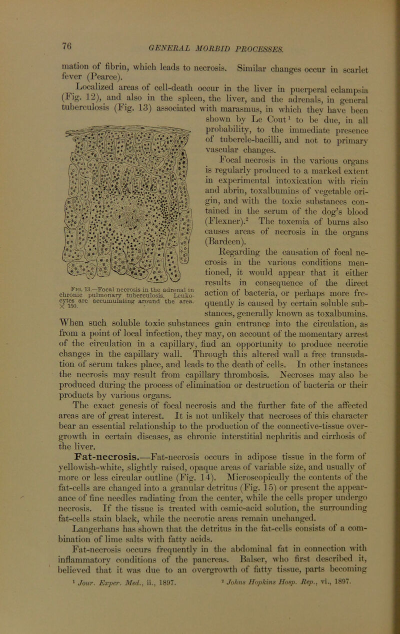 ’nation of fibrin, which leads to necrosis. Similar changes occur in scarlet fever (Pearce). Localized areas of cell-death occur in the liver in puerperal eclampsia (big. 12), aud also in the spleen, the liver, and the adrenals, in general tuberculosis (Fig. 13) associated with marasmus, in which they have been shown by Le Cout1 to be* due, in all probability, to the immediate presence of tubercle-bacilli, and not to primary vascular changes. Focal necrosis in the various organs is regularly produced to a marked extent in experimental intoxication with ricin and abrin, toxalbumins of vegetable ori- gin, and with the toxic substances con- tained in the serum of the dog’s blood (Flexner).2 The toxemia of burns also Regarding the causation of focal ne- crosis in the various conditions men- tioned, it would appear that it either results in consequence of the direct action of bacteria, or perhaps more fre- quently is caused by certain soluble sub- stances, generally known as toxalbumins. When such soluble toxic substances gain entrance into the circulation, as from a point of local infection, they may, on account of the momentary arrest of the circulation in a capillary, find an opportunity to produce necrotic changes in the capillary wall. Through this altered wall a free transuda- tion of serum takes place, and leads to the death of cells. In other instances the necrosis may result from capillary thrombosis. Necroses may also be produced during the process of elimination or destruction of bacteria or their products by various organs. The exact genesis of focal necrosis and the further fate of the affected areas are of great interest. It is not unlikely that necroses of this character bear an essential relationship to the production of the connective-tissue over- growth in certain diseases, as chronic interstitial nephritis and cirrhosis of the liver. Fat-necrosis.—Fat-necrosis occurs in adipose tissue in the form of yellowish-white, slightly raised, opaque areas of variable size, and usually of more or less circular outline (Fig. 14). Microscopically the contents of the fat-cells are changed into a granular detritus (Fig. 15) or present the appear- ance of fine needles radiating from the center, while the cells proper undergo necrosis. If the tissue is treated with osmic-acid solution, the surrounding fat-cells stain black, while the necrotic areas remain unchanged. Langerhans has shown that the detritus in the fat-cells consists of a com- bination of lime salts with fatty acids. Fat-necrosis occurs frequently in the abdominal fat in connection with inflammatory conditions of the pancreas. Balser, who first described it, believed that it was due to an overgrowth of fatty tissue, parts becoming 1 Jour. Expcr. Med., ii., 1897. 2 Johns Hopkins llosp. Rep., vi., 1897. causes areas of necrosis in the organs (Bardeen). Fig. 13.—Focal necrosis in the adrenal in chronic pulmonary tuberculosis. Leuko- cytes are accumulating around the area. X 150.
