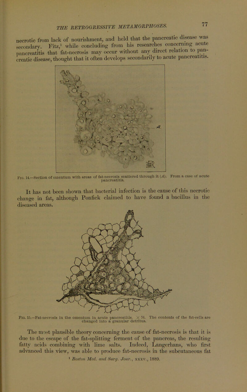 i necrotic from lack of nourishment, and held that the pancreatic disease was secondary. Fit/,1 while concluding from his researches concerning acute pancreatitis that fat-necrosis may occur without any direct relation to pan- creatic disease, thought that it often develops secondarily to acute pancreatitis. Pig. 15.—Fat-necrosis in the omentum in acute pancreatitis. X 16. The contents of the fat-cells are changed into a granular detritus. The most plausible theory concerning the cause of fat-necrosis is that it is due to the escape of the fat-splitting ferment of the pancreas, the resulting- fatty acids combining with lime salts. Indeed, Langcrhans, who first advanced this view, was able to produce fat-necrosis in the subcutaneous fat 1 Boston Med. and Surg. Jour., xxxv., 1889. Fig 14.—Section of omentum with areas of fat-necrosis scattered through it (-A). From a case ol acute pancreatitis. It has not been shown that bacterial infection is the cause of this necrotic change in fat, although Ponfick claimed to have found a bacillus in the diseased areas.
