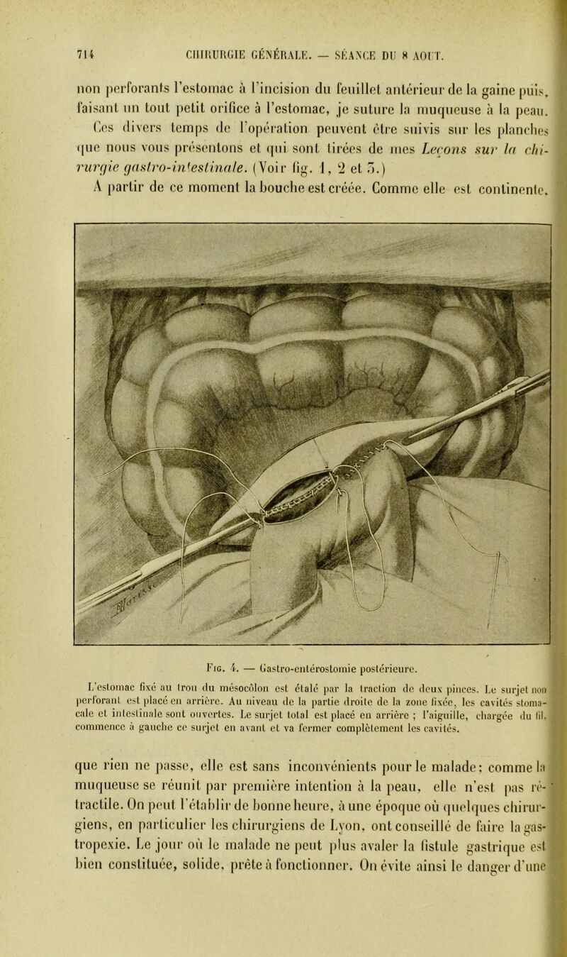 non perforants restoinac à l’incision du feuillet antérieur de la gaine puis, faisant un tout jietit orifice à l’estoinac, je suture la muqueuse à la peau. (les divers temps de l’opération peuvent être suivis sur les planclies que nous vous présentons et (pii sont tiiées de mes Levons sur la chi- rurgie rjasfro-inieslinale. (Voir lig. 1, '2 et ô.) A partir de ce moment la bouche est créée. Comme elle est continente. Eig. 4. — Gastro-cnlérostoinie poslérieurc. L'csioniac fixé au Iroii du mésocôlon est élalc par la traction de deux pinces. Lu surjet non perlorant est |ilacé en arrière. Au niveau de la partie droite de la zone fixée, les cavités stoma- cale cl inleslinale sont ouvertes, l.e surjet total est placé eu arrière ; l’aiguille, chargée du lil. commence à gauche ce sinjct en avant et va fermer complèlemeut les cavités. que rien ne liasse, elle est sans inconvénients pour le malade; comme la muqueuse se réunit par premitu’e intention à la peau, elle n’est pas iv- tractile. On peut l’établir de bonne heure, aune époque où (jiielques chirur- giens, en particulier les chirurgiens de J.yon, ont conseillé de faire lagas- tropexie. Le jour où le malade ne peut |)lus avaler la fistule gastrique est bien constitutte, solide, jiréte à fonctionner. On évite ainsi le danger d’une