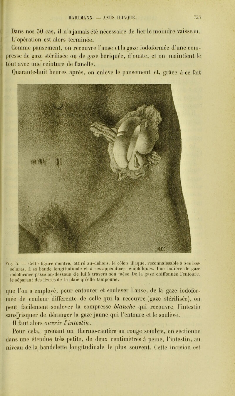 Dans nos ÔO oas, il n’a jamaiscHô nôoossairo do lier lo moindre vaisseau, l/opéi'alion est alors terminée. Comme pansemcnl, on recouvre l’anse et la gaze iodorormée d’une cuiii- presse de gaze stérilisée ou de gaze l)ori(piée, d’ouate, et on maintient le loul avec une e(Mnture de llanelle. Quaranic-huit heures après, on enlève le pansement (d, grâce à ce l'ait Fip:. .■). — Celle ligure nioiiti e. atliré au-deliors. le colon iliaque, reconnaissable à ses bos- selui'es, à sa bande longitudinale et à ses appendices épiploïques. Une lanière de gaze ioflolorinéc passe au-dessous de lui à travers son inéso. Ile la gaze cbillbnnée l’entoure, le séparant des lèvres de la plaie qu'elle tamponne. que l’on a employé, pour entourer et soulever l’anse, de la gaze iodoror- mée de couleur diiïérente de celle qui la recouvre (gaze stérilisée), on peut facilement soitlcver la compresse blanche tpii recouvre rintestiii sansrisquer de déranger la gaze jaune qui l’entoure et le soulève. 11 faut alors ouvrir VinLestin. Pour cela, prenant un thermo-cautère au rouge somhre, on sectionni' dans une étendue très petite, de deux centimètres à peine, l’intestin, au niveau de la bandelette longitudinale le plus souvent. Celte incision est
