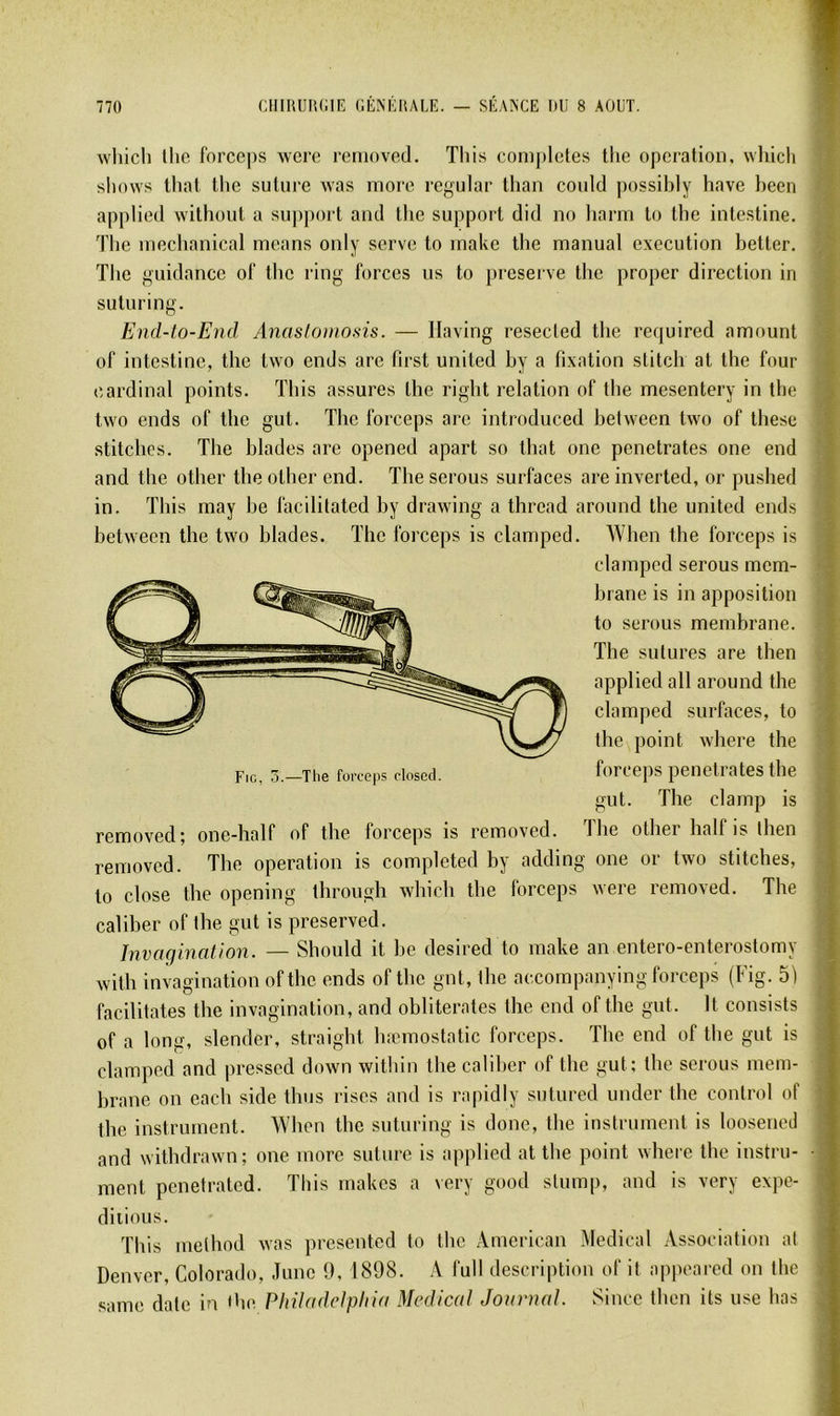 whicli Iho forceps werc rernoved. This coniplcles tlie operation, wliicli shows thaï llie suture was more regular than could possibly hâve heen applied without a suppoi t and the support did no liarrn lo the intestine. The inechanical means oïdy serve to inake the manual execution better. The guidance of the ring forces us to preserve the proper direction in suluring. End-to-End Anasloinosis. — llaving resecled the required amount of intestine, the two ends are first uniled hy a fixation stitch at the four cardinal points. This assures the right relation of tlie mesentery in the ^ two ends of the gui. The forceps are introduced hetween two of tliese .stilchos. The blades are opened apart so that one pénétrâtes one end and the other the other end. The serous surfaces are inverted, or pushed in, This may he facilitated hy drawing a thread around the united ends hetween the two blades. The forceps is claniped. When the forceps is i rernoved; one-half of the forceps is rernoved. The other half is then rernoved. The operation is completed hy adding one or two stitches, lo close the opening through wliich the forceps were rernoved. The caliber of the gut is preserved. Invagination. — Should it he desired to make an entero-enterostomy wilh invagination of the ends of the gnt, the accompanying forceps (Fig. 51 facilitâtes the invagination, and oblitérâtes the end of the gut. It consists of a long, slender, straight hæinostatic forceps. The end of the gut is claniped and pressed down within the caliber of the gut: the serous mem- brane on each side thus rises and is rapidiy sutured under the control of the instrument. When the suturing is doue, the instrument is loosened ■ and withdrawn; one more suture is applied at the point where the instru- • ment penetrated. This makes a \ery good stump, and is very expe- diiious. This melhod was presented to the American Medical Association at Denver, Colorado, June 9, 1898. A full description of it appoared on the same date in 'he Philadelphia Medical Journal. Since then ils use lias clamped serous mem- hrane is in apposition t Fio, ù.—The forceps closed. to serons membrane. The sutures are then applied ail around the clamped surfaces, to the point where the forceps pénétrâtes the gut. The clamp is