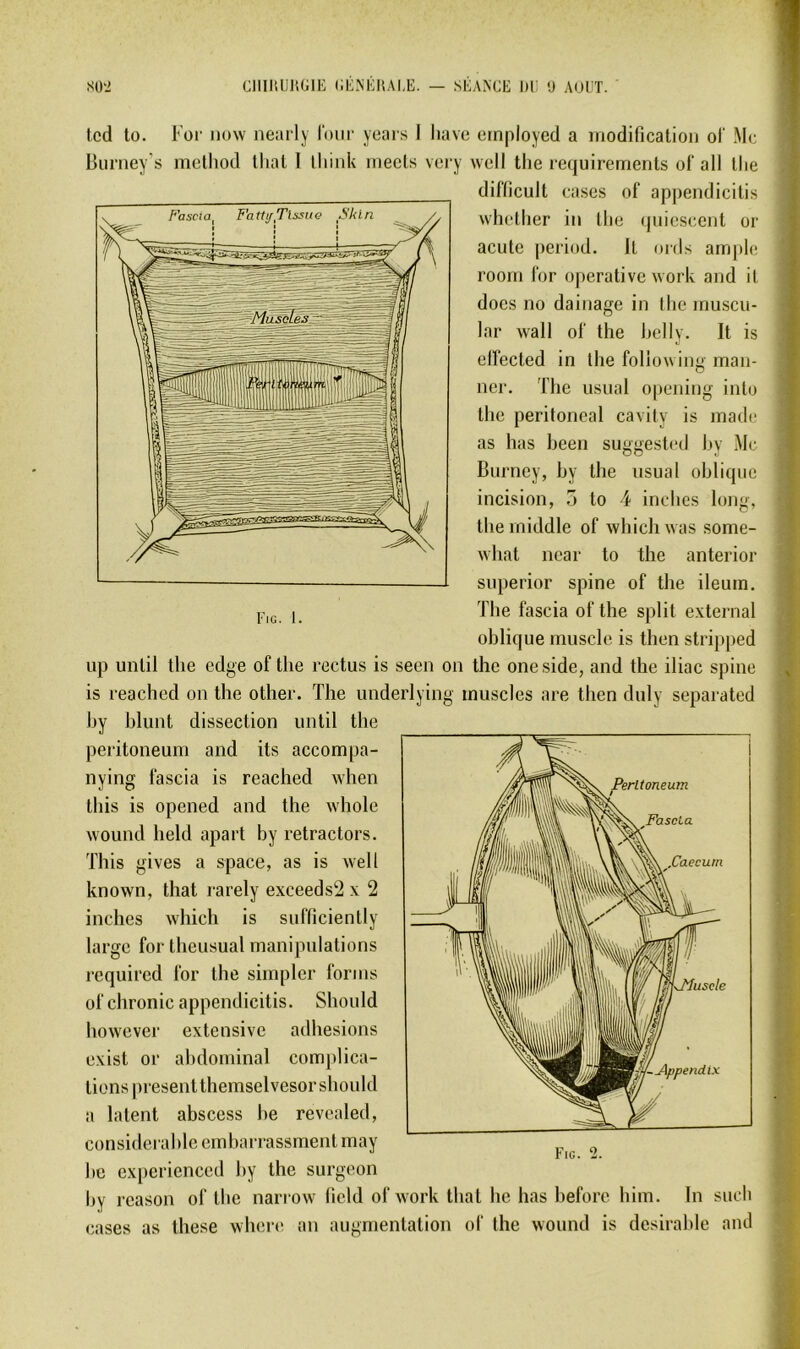 Burney's method thaï I lliink mecls very wcll the requirements ol' ail llie dilïicult cases of appendicilis whctiier in tlic quiescent or acute period. Il ords ample room for operative work and it docs no dainage in the muscu- lar wall of the hclly. It is cllected in the foliowing man- ner. The usual opening inlo the peritoneal cavily is made as lias been suggested hy Mc Burney, hy the usual oblique incision, 5 to 4 inches long, the middle of whicliivas some- ivhat ncar to the anterior superior spine of the ileum, The fascia of the split external oblique muscle is tlien stripped up until the edge of the reclus is seen on the one side, and the iliac spine is reachcd on the other. The underlying muscles are then duly separated hy hlunt dissection until the peritoneum and its accompa- nying fascia is reached when tins is opened and the whole wound held apart by retractors. This gives a space, as is well known, that rarely exceeds2 x 2 inches which is sufficiently large for theusual manipulations required for the simpler forms of chronic appendicilis. Should however extensive adhesions exist or abdominal complica- tions presentthemselvesor should a latent abscess he revealed, considérable embarrassment may he experienced hy the surgeon hy reason of the nari ovv field of work that he lias hefore him. In such cases as these wheia^ an auementalion of the wound is désirable and