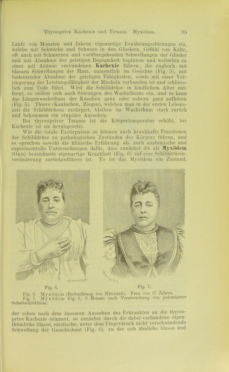 Laufe von Monaten und Jahren eigenartige Ernährungsstörungen ein, welche mit Schwäche und Schwere in den Gliedern, (Jefühl von Kälte, oft auch mit Schmerzen und vorübergehenden Schwellungen der Glieder und mit Abnahme der geistigen Regsamkeit beginnen und weiterhin zu einer mit Anämie verbundenen Kachexie führen, die zugleich mit blassen Schwellungen der Haut, namentlich im Gesichte (Fig. 5), mit bedeutender Abnahme der geistigen Fähigkeiten, sowie mit einer Ver- ringerung der Leistungsfähigkeit der Muskeln verbunden ist und schliess- lich zum Tode führt. Wird die Schilddrüse in kindlichem Alter ent- fernt, so stellen sich auch Störungen des Wachsthums ein, und es kann das Längenwachsthum der Knochen ganz oder nahezu ganz aufhören (Fig. 5). Thiere (Kaninchen, Ziegen), welchen man in der ersten Lebens- zeit die Schilddrüsen exstirpirt, bleiben im Wachsthum stark zurück und bekommen ein stupides Aussehen. Rei thyreopriver Tetanie ist die Körpertemperatur erhöht, bei Kachexie ist sie herabgesetzt. Wie die totale Exstirpation so können auch krankhafte Functionen der Schilddrüse zu pathologischen Zuständen des Kö]'|)ers führen, und es sprechen sowohl die klinische Erfahrung als auch anatomische und experimentelle Untersuchungen dafür, dass zunächst die als Myxödem (Ord) bezeichnete eigenartige Krankheit (Fig. 6) auf eine Schilddrüsen- veränderung zurückzuführen ist. Fs ist das Myxödem ein Zustand, Fig. 6. Rig- 7. Fig. 6. Myxödem (Beobachtung von MEi/rzEß). Frau von 37 Jahren. Fig. 7. Myxödem Fig. ü, 3 Monate nach Verabreichung von pulverisirter Schafsscnilddriise. der schon nach dem äusseren Aussehen des Erkrankten an die thyreo- prive Kachexie erinnert, so zunächst durch die dabei vorhandene eigen- thümliche blasse, elastische, unter dem Fingerdruck nicht verschwindende Schwellung der Gesichtshaut (Fig. (i), zu der sich ähnliche blasse und