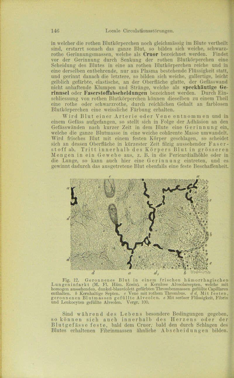 in welcher die rothen Blutkörperchen noch gleichinässig iin Blute vertheilt sind, erstarrt sonach das ganze Blut, so bilden sich weiche, schwarz- rothe Gerinnungsinassen, welche als Cnior bezeichnet werden. Findet vor der Gerinnung durch Senkung der rothen Blutkörperchen eine Scheidung des Blutes in eine an rothen Blutkörperchen reiche und in eine derselben entbehrende, nur aus Plasma bestehende Flüssigkeit statt, und gerinnt danach die letztere, so bilden sich weiche, gallertige, leicht gelblich gefärbte, elastische, an der Oberfläche glatte, der Gefässwand nicht anhaftende Klumpen und Stränge, welche als speckhUutige Ge- rinnsel oder Fascrstoffiabscheidungen bezeichnet werden. Durch Ein- schliessung von rothen Blutkörperchen können dieselben zu einem Theil eine rothe oder schwarzrothe, durch reichlichen Gehalt an farblosen Blutkörperchen eine weissliche Färbung erhalten. Wird Blut einer Arterie oder Vene entnommen und in einem Gefäss aufgefangen, so stellt sich in Folge der Adhäsion an den Gefässwänden nach kurzer Zeit in dem Blute eine Gerinnung ein, welche die ganze Blutmasse in eine weiche cohärente Masse umwandelt. Wird frisches Blut mit einem festen Körper geschlagen, so scheidet sich an dessen Oberfläche in kürzester Zeit filzig aussehender Faser- stoff ab. Tritt innerhalb des Körpers Blut in grösseren Mengen in ein Gewebe aus, z. B. in die Pericardialhöhle oder in die Lunge, so kann auch hier eine Gerinnung eintreten, und es gewinnt dadurch das ausgetretene Blut ebenfalls eine feste Beschatfenheit. ’S ' I Fig. 12. Geronnenes Blut in einem frischen h.Hmorrhagischen Lungen infarkt (M. Fl. Häm. Eosin), a Kernlose Alveol.arscpten, welche mit homogen aussehenden, dunkel-blauviolett gefärbten Thrombenmassen gefüllte Capillaren enthalten, h Kernhaltige Septen. c Vene mit rothem Thrombus, rf rf, .Mit festen, geronnenen Blutmassen gefüllte Alveolen, e IMit seröser Flüssigkeit, Fibrin und Leukocyten gefüllte Alveolen. Vergr. 100. Sind während des Lebens besondere Bedingungen gegeben, s 0 k ö n n e n sich a n c h i n n e r h a 1 b des II e r z e n s oder der Blutgefässe feste, bald dem Cruor, bald den durch Schlagen des Blutes erhaltenen Fibrinmassen ähnliche Abscheidungen bilden.