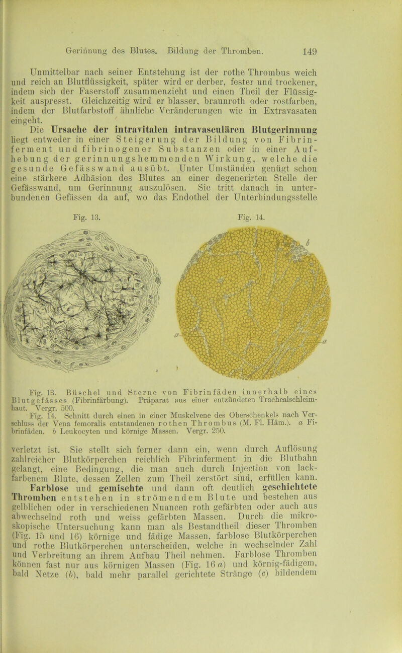 Unmittelbar nach seiner Entstehung ist der rothe Thrombus weich und reich an Blutflüssigkeit, später wird er derber, fester und trockener, indem sich der Faserstoff zusamnienzieht und einen Theil der Flüssig- keit auspresst. Gleichzeitig wird er blasser, braunroth oder rostfarben, indem der Blutfarbstoff ähnliche Veränderungen wie in Extravasaten ein geht. Die Ursache der iiitraTitalen iiitraTasculäreii Blutgerinnung liegt entweder in einer Steigerung der Bildung von Fibrin- ferment und fibrinogener Substanzen oder in einer Auf- hebung der g e r i n n u n g s h e m m e n d e n Wirkung, welche die gesunde G e f ä s s av a n d a u s ü b t. Unter Umständen genügt schon eine stärkere Adhäsion des Blutes an einer degenerirten Stelle der Gefässwand, um Gerinnung auszulösen. Sie tritt danach in unter- bundenen Gefässen da auf, wo das Endothel der Unterbindungsstelle Fig. 13. Fig. 14. Fig. 13. Büschel und Sterne von Fibrinfäden innerhalb eines Blutgefässes (Fibrinfärbung). Präparat aus einer entzündeten Trachealschleim- haiit. \'ergr. 500. Fig. 14. Schnitt durch einen in einer Muskelvene des Oberschenkels nach Ver- schluss der Vena femoralis entstandenen rothen Thrombus (M. Fl. Häm.), a Fi- brinfäden. b Leukocyten und körnige Massen. Vergr. 250. verletzt ist. Sie stellt sich ferner dann ein, wenn durch Auflösung zahlreicher Blutkörperchen reichlich Fibrinferment in die Blutbahn gelangt, eine Bedingung, die man auch durch Injection von lack- farbenem Blute, dessen Zellen zum Theil zerstört sind, erfüllen kann. Farblose und gemischte und dann oft deutlich geschichtete Thromben entstehen in strömendem Blute und bestehen aus gelblichen oder in verschiedenen Nuancen roth gefärbten oder auch aus abwechselnd roth und tveiss gefärbten Massen. Durch die mikro- skopische Untersuchung kann man als Bestandtheil dieser Thromben (Fig. 15 und IG) körnige und fädige Massen, farblose Blutkörperchen und rothe Blutkörperchen unterscheiden, welche in wechselnder Zahl und Verbreitung an ihrem Aufbau Theil nehmen. Farblose Thromben können fast nur aus körnigen Massen (Fig. 16 a) und körnig-lädigem, bald Netze (/;), bald mehr parallel gerichtete Stränge (c) bildendem