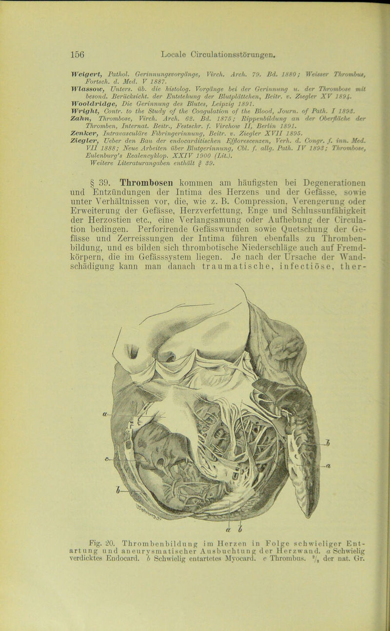Weigevt, Pathol. Gerinnungsvorgänge, Vireh. Arch. 70. Bd. 1880; WeUser Thrombus, Fortsch. d. Med. V 1887. Wlassoiv, Unters, üb. die histolog. Vorgänge bei der Gerinnnruj «. der Thrombtjse mit besond. Berüelcsiclit. der Entstehung der Blutplättchen, Beitr. v. Ztegler XV 1894. Wooldridge, Die Gerinnung des Blutes, Leipzig 1801. Wright, Conlr. to the Study of the Coagulation of the Blood, Journ. of Path. I 1893. Zahn, Thrombose, Vireh. Arch. 62. Bd. 1875; Rippenbildung an der Oberfläche der Thromben, Internat. Beitr., Festschr. f. Virchow II, Berlin 1801. Zenlcct', Intravasculäre Fibringerinnung, Beitr. v. Ziegler XVII 1895. Ziegler, Ueber den Bau. der endocarditischen Efflorescenzen, Verh. d. Congr. /. inn. Med. VII 1888; Neue Arbeiten über Blutgerinnung, Cbl. f. allg. Path. IV 1893; Thrombose, Eulenburg’s Rcalencyldop. XXIV 1900 (Lit.). Weitere Literaturangaben enthält § 39. § 39. Thrombosen kommen am häuligsten bei Degenerationen und Entzündungen der Intima des Herzens und der Gefässe, sowie unter Verhältnissen vor, die, wie z. B. Compression, ^'erengerung oder Erweiterung der Gefässe, Herzverfettung, Enge und Schlussunfähigkeit der Herzostien etc., eine Verlangsamung oder Aufhebung der Circula- tion bedingen. Perforirende Gefässwunclen sowie Quetschung der Ge- fässe und Zerreissuugen der Intima führen ebenfalls zu Thromben- bildung, und es bilden sich thrombotische Niederschläge auch auf Fremd- körpern, die im Gefässsystem liegen. Je nach der Ursache der Wand- schädigung kann man danach traumatische, infectiöse, ther- Fig. 20. Thrombcnbildung ini Herzen in Folge schwieliger Ent- artung und an eurysm ati scher Ausbuchtung der Herzwand. «Schwielig verdicktes Endocard. h Schwielig entartetes Myocarcl. c Thrombus. , der nat. Gr.