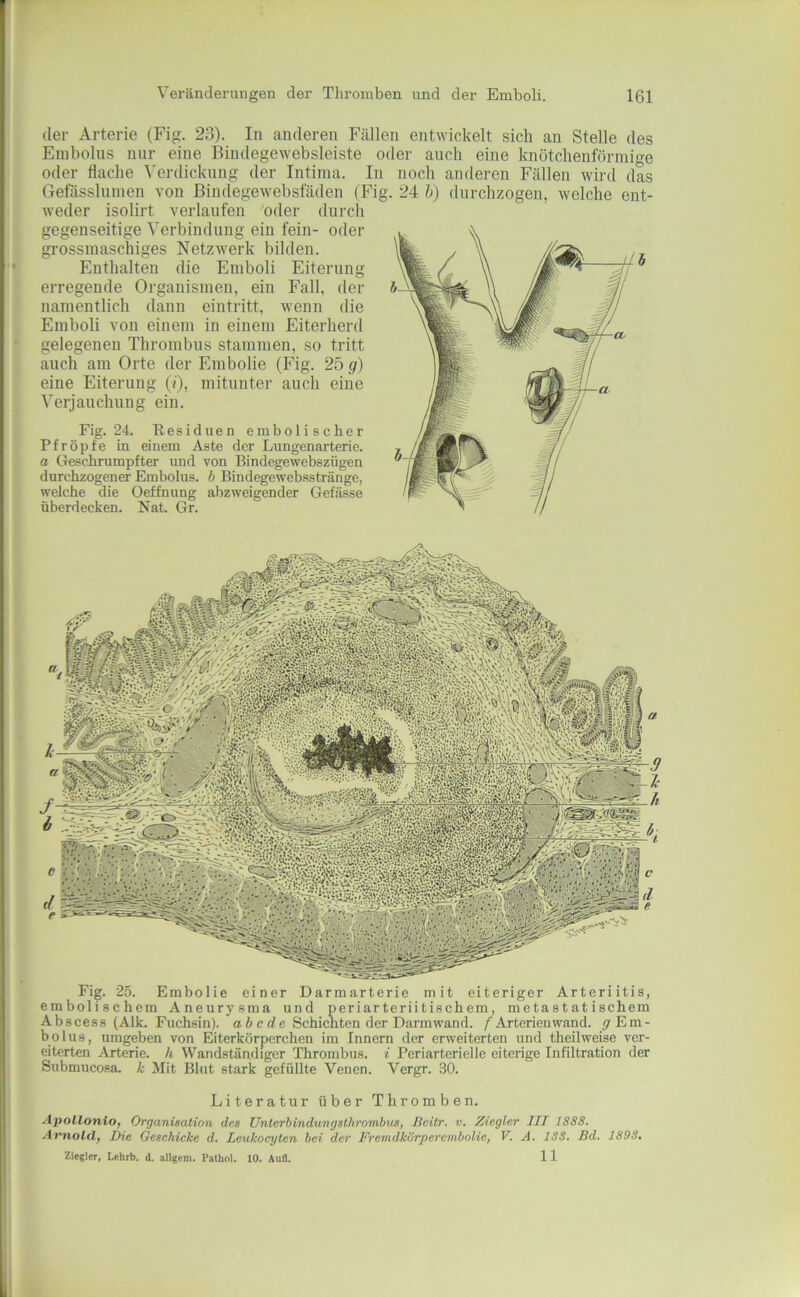 Fig. 24. Besiduen embolischer Pfropfe in einem Aste der Lungenarterie. a Geschrumpfter und von Bindegewebszügen durchzogener Embolus, b Bindegewebsstränge, welche die Oeffnung abzweigender Gefässe überdecken. Nat. Gr. der Arterie (Fig. 23). In anderen Fällen entwickelt sich an Stelle des Embolus nur eine Bindegewebsleiste oder aucli eine knötchenförmige oder flache Verdickung der Intima. In noch anderen Fällen wird das Gefässlnmen von ßindegewebsfäden (Fig. 24 h) durchzogen, welche ent- weder isolirt verlaufen oder durch gegenseitige Verbindung ein fein- oder grossmaschiges Netzwerk bilden. Enthalten die Emboli Eiterung erregende Organismen, ein Fall, der namentlich dann eintritt, wenn die Emboli von einem in einem Eiterherd gelegenen Thrombus stammen, so tritt auch am Orte der Embolie (Fig. 25 g) eine Eiterung (/), mitunter auch eine Verjauchung ein. Fig. 25. Embolie einer Darmarterie mit eiteriger Arteriitis, embolischem Aneurysma und periarteriitischem, m e ta s t at i schem Ab scess (Alk. Fuchsin), ’abcde Schichten der Darmwand. / Arterien wand, Em- bolus, umgeben von Eiterkörperchen im Innern der erweiterten und theilweise ver- eiterten Arterie, h Wandständiger Thrombus, i Periartcrielle eiterige Infiltration der Submucosa. k Mit Blut stark gefüllte Venen. Vergr. 30. Literatur über Thromben. ApoLlonio, Organisation des ünlcrbindungsthrombus, Bcitr. v, Ziegler III 1888. Arnold, Die Geschicke d. Leukocyten bei der Fremdkörperembolie, V. A. ISS. Bd. 1S9S. Ziegler, Lehrb. d. allgcm. Pathol. 10. Aull. 11