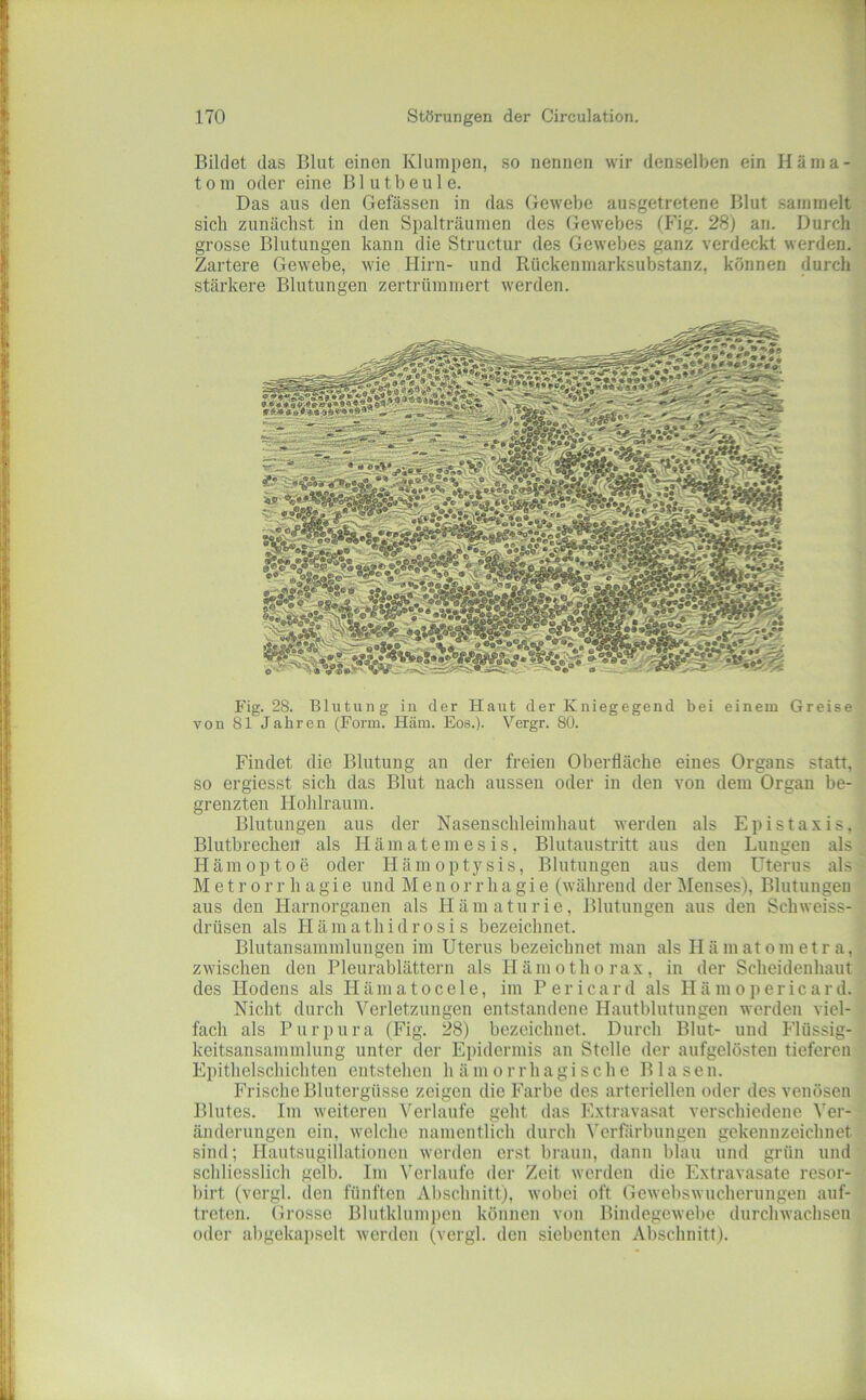 Bildet das Blut einen Klumpen, so nennen wir denselben ein Hänia- 10 in oder eine B1 u t b e u 1 e. Das aus den Gefässen in das Gewebe ausgetretene Blut sammelt sich zunächst in den Spalträumen des Gewebes (Fig. 28) an. Durch grosse Blutungen kann die Structur des Gewebes ganz verdeckt werden. Zartere Gewebe, wie Hirn- und Rückenniarksubstanz, können durch stärkere Blutungen zertrümmert werden. Fig. 28. Blutung in der Haut der Kniegegend bei einem Greise von 81 Jahren (Form. Häm. Eos.). Vergr. 80. Findet die Blutung an der freien Oberfläche eines Organs statt, so ergiesst sich das Blut nach aussen oder in den von dem Organ be- grenzten Hohlraum. Blutungen aus der Nasenschleimhaut werden als Epistaxis, Blutbrechen als Hämatemesis, Blutaustritt aus den Lungen als Hämoptoe oder Hämoptysis, Blutuiigeu aus dem Uterus als M e t r 0 r r h a gi e und Menorrhagie (während der l\Ienses), Blutungen aus den Hariiorganen als Hämaturie, Blutungen aus den Schweiss- drüsen als H äin a th i d r o s i s bezeichnet. Blutausammluiigeu im Uterus bezeichnet man als Hämatometra, zwischen den Pleurablättern als Häiuothorax, in der Scheidenhaut des Hodens als Hämatocele, im Pericard als Hä mopericard. Nicht durch Verletzungen entstandene Hautblutungen werden viel- fach als Purpura (Fig. 28) bezeichnet. Durch Blut- und Flüssig- keitsansauunlung unter der Epidermis an Stelle der aufgelösten tieferen Epithelschichten entstehen hämorrhagische Blasen. Frische Blutergüsse zeigen die Farbe des arteriellen oder des venösen Blutes. Im weiteren Verlaufe geht das Extravasat verschiedene Ver- änderungen ein, welche namentlich durch Verfärbungen gekennzeichnet sind; Hautsngillationen werden erst braun, dann blau und grün und schliesslich gell). Im Verlaufe der Zeit werden die Extravasate resor- birt (vergl. den fünften Abschnitt), wobei oft Gewebswucherungen auf- treten. Grosse Blutklumpen können von Bindegewebe durchwachsen oder abgekapselt werden (vergl. den siebenten Abschnitt).