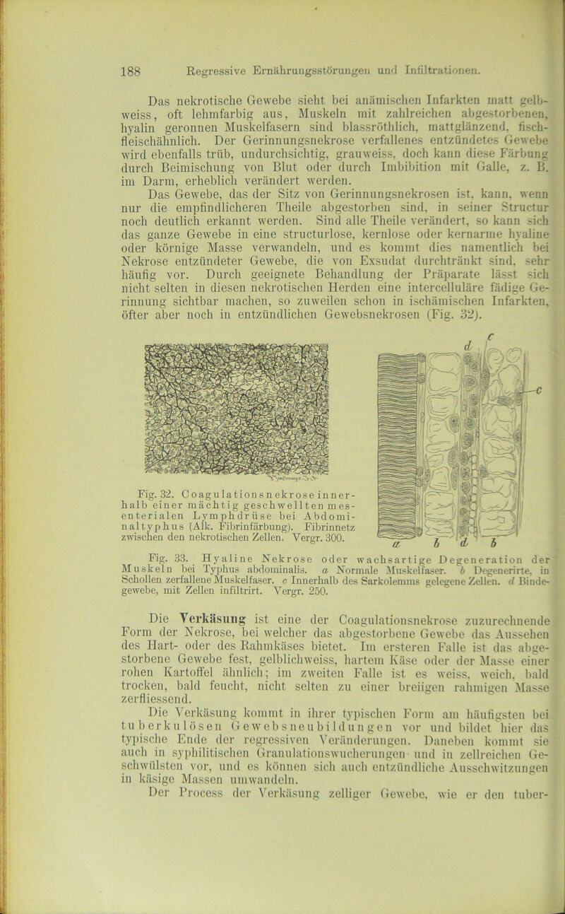 Das nekrotische Gewebe sieht bei anämischen Infarkten matt gelb-| weiss, oft lehmfarbig aus, Muskeln mit zalilreichen abgestorbenen, hyalin geronnen Muskelfasern sind blassröthlich, mattglänzend, fisch-| fleischähnlich. Der Gerinnungsnekrose verfallenes entzündetes Gewebej l wird ebenfalls trüb, undurchsichtig, grauweiss, doch kann diese Färbung ^ | durch Beimischung von Blut oder durch Imbibition mit Galle, z. B.'^ im Darm, erheblich verändert werden. ^ Das Gewebe, das der Sitz von Gerinnungsnekrosen ist, kann, wennlj- nur die empfindlicheren Theile abgestorben sind, in seiner Structuri'^;/ noch deutlich erkannt werden. Sind alle Theile verändert, so kann sich das ganze Gewebe in eine structurlose, kernlose oder kernarme hyaline ? oder körnige Masse verwandeln, und es kommt dies namentlich bei;;, Nekrose entzündeter Gewebe, die von Exsudat durchtränkt sind, sehr häufig vor. Durch geeignete Behandlung der Prä])arate lässt sich r ! nicht selten in diesen nekrotischen Herden eine intercelluläre fädige Ge-I- rinnung sichtbar machen, so zuweilen schon in ischämischen Infarkten, ;^ öfter aber noch in entzündlichen Gewebsnekrosen (Fig. 32j. T ! Fig. 33. Hyaline Nekrose oder wachsartige Degeneration der ^ Muskeln bei Typhus abdominalis, a Normale Muskelfaser, b Degenerirte, in Schollen zerfallene Muskelfaser, c Innerhalb des Sarkolemms gelegene Zellen, d Binde- gewebe, mit Zellen infiltrirt. Vergr. 250. Fig. 32. Coagulation s n ekrose inner- halb einer mächtig geschwellten mes- enterialen Lymphdrüse bei Abdomi- naltyphus (Alk. Fibi'infärbung). Fibrinnetz zw’ischen den nekrotischen Zellen. Vergr. 300. Die Verkäsung ist eine der Coagulatiousnekrose zuzurechnende ; Form der Nekrose, bei welcher das abgestorbene Gewebe das Aussehen des Hart- oder des Rahmkäses bietet. Im ersteren Falle ist das abge- ; storbene Gewebe fest, gelblichweiss, hartem Käse oder der blasse einer' rohen Kartofiel ähnlicli; im zweiten Falle ist es weiss. weich, bald trocken, bald feucht, nicht selten zu einer breiigen rahmigen Masse zerfliessend. Die Verkäsung kommt in ihrer ty])ischen Form am häufigsten bei. t u 1) e r k u 1 ö s e n G e w c b s u e u b i 1 d’u n g e u vor und bildet hier das tyi)ische Ende der regressiven Veränderungen. Daneben kommt sie auch in sy])hilitischen Granulationswucherungen und in zellreicheu Ge- schwülsten vor, und es können sich auch entzündliche Ausschwitzungen in käsige Massen umwandcln. Der Process der Verkäsung zelliger Gewelie, wie er den tuber-