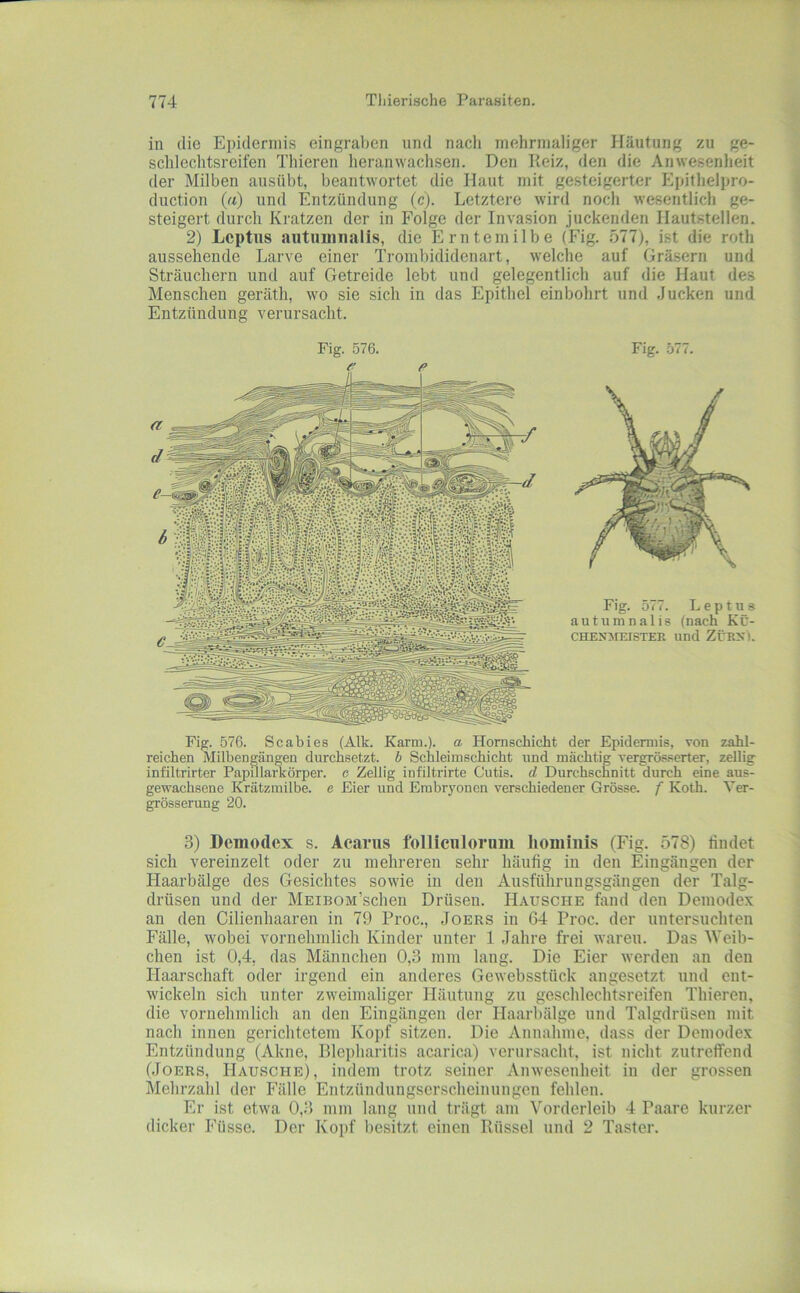 in die Epidermis eingraben und nach inehnnaliger Häutung zu ge- schlechtsreifen Thieren heranwachsen. Den Pieiz, den die Anwesenlieit der Milben ausübt, beantwortet die Haut mit gesteigerter Epitlielpro- duction (a) und Entzündung (c). Letztere wird noch wesentlich ge- steigert durch Kratzen der in Folge der Invasion juckenden Hautstellen. 2) Leptus autuinnalis, die Erntemilbe (Fig. 577), ist die roth aussehende Larve einer Trombididenart, welche auf Gräsern und Sträuchern und auf Getreide lebt und gelegentlich auf die Haut des Menschen geräth, wo sie sich in das Epithel einbohrt und Jucken und Entzündung verursacht. Fig. 576. Fig. 577. Fig. 577. Leptus autumnalis (nach Kü- CHENJrEISTER und ZiTRX). Fig. 576. Scabies (Alk. Karm.). a Hornschicht der Epidermis, von zahl- reichen Milbengängen durchsetzt, b Scbleimschicht und mächtig vergrösserter, zellig infiltrirter PapOlarkörper. c Zellig infiltrirte Cutis, d Durchschnitt durch eine aus- gewachsene Krätzmilbe, e Eier und Erabrjmnen verschiedener Grösse, f Koth. Ver- grösserung 20. 3) Demodex s. Acarus folliciilorum houiinis (Fig. 578) findet sich vereinzelt oder zu mehreren sehr häufig in den Eingängen der Haarbälge des Gesichtes sowie in den Ausführungsgängen der Talg- drüsen und der MEinoM’schen Drüsen. Hausche fand den Demode.x an den Cilienhaaren in 79 Proc., Joers in 64 Proc. der untersuchten Fälle, wobei vornehmlich Kinder unter 1 Jahre frei waren. Das Weib- chen ist 0,4, das Männchen 0,3 mm lang. Die Eier werden an den Haarschaft oder irgend ein anderes Gewebsstück angesetzt und ent- wickeln sich unter zweimaliger Häutung zu geschlechtsreifen Thieren, die vornehmlich an den Eingängen der Haarbälge und Talgdrüsen mit nach innen gerichtetem Kopf sitzen. Die Annahme, dass der Demodex Entzündung (Akne, Blepharitis acarica) verursacht, ist nicht zutreffend (Joers, Hausche), indem trotz seiner Anwesenheit in der grossen Mehrzald der Fälle Entzündungserscheimingen fehlen. Er ist etwa 0,3 mm lang und trägt am Vorderleib 4 Paare kurzer dicker Füsse. Der Kopf besitzt einen Rüssel und 2 Taster.