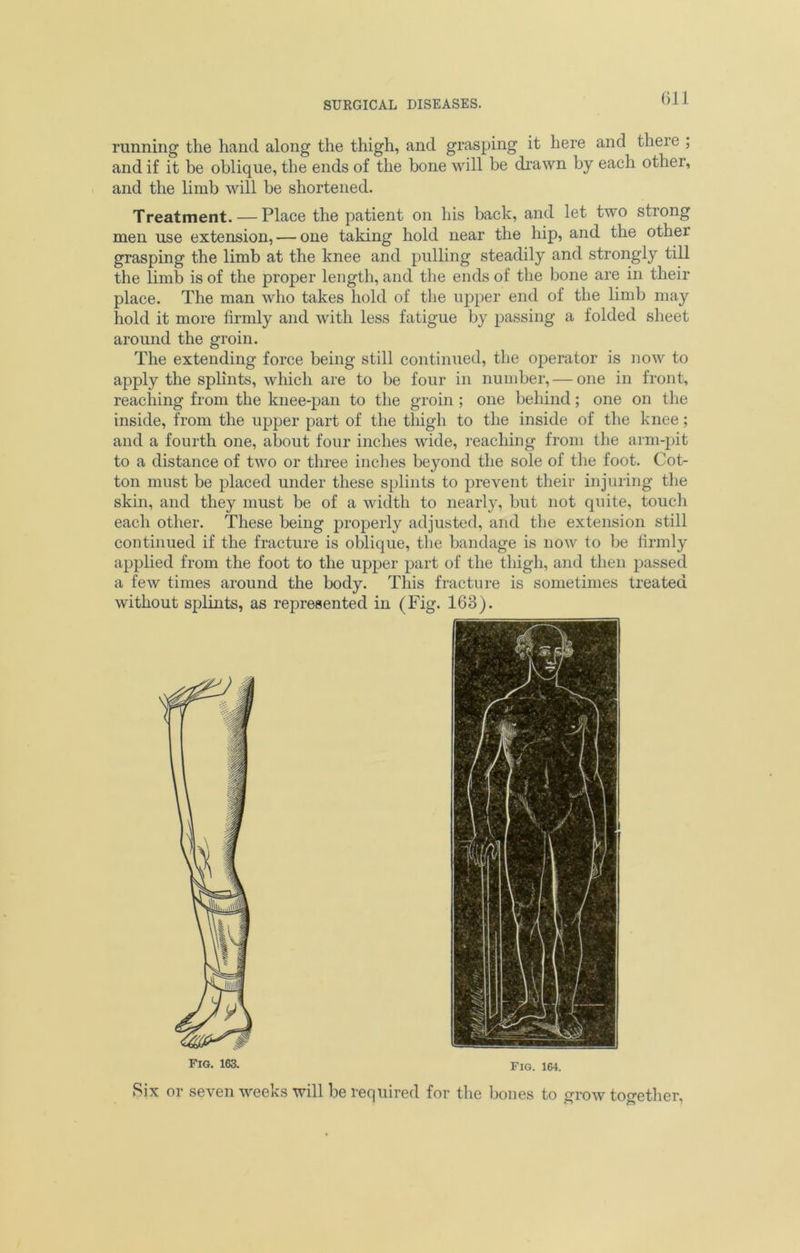 running the hand along the thigh, and grasping it here and there ; and if it be oblique, the ends of the bone will be drawn by each othei, and the limb will be shortened. Treatment. — Place the patient on his back, and let two strong men use extension, — one taking hold near the hip, and the other grasping the limb at the knee and pulling steadily and strongly till the limb is of the proper length, and the ends of the bone are in their place. The man who takes hold of the upper end of the limb may hold it more firmly and with less fatigue by passing a folded sheet around the groin. The extending force being still continued, the operator is now to apply the splints, which are to be four in number, — one in front, reaching from the knee-pan to the groin; one behind; one on the inside, from the upper part of the thigh to the inside of the knee; and a fourth one, about four inches wide, reaching from the arm-pit to a distance of two or three inches beyond the sole of the foot. Cot- ton must be placed under these splints to prevent their injuring the skin, and they must be of a width to nearly, but not quite, touch each other. These being properly adjusted, and the extension still continued if the fracture is oblique, the bandage is now to be firmly applied from the foot to the upper part of the thigh, and then passed a few times around the body. This fracture is sometimes treated without splints, as represented in (Fig. 163). Fig. 163. Fig. 164. Six or seven weeks will be required for the bones to grow together.