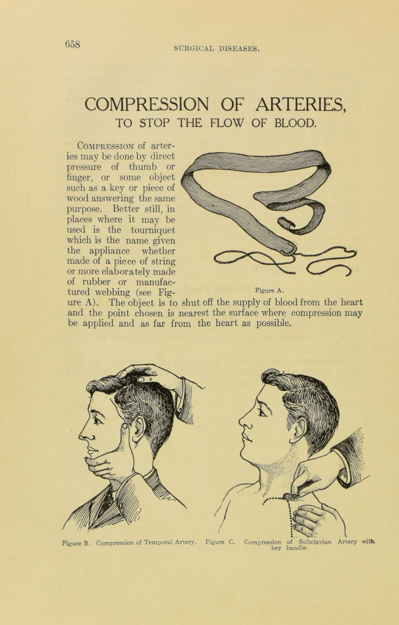 SURGICAL DISEASES. COMPRESSION OF ARTERIES, TO STOP THE FLOW OF BLOOD. Compression of arter- ies may be done by direct pressure of thumb or finger, or some object such as a key or piece of wood answering the same purpose. Better still, in places where it may be used is the tourniquet which is the name given the appliance whether made of a piece of string or more elaborately made of rubber or manufac- tured webbing (see Fig- Figure A> ure A). The object is to shut off the supply of blood from the heart and the point chosen is nearest the surface where compression may be applied and as far from the heart as possible. Figure B. Compression of Temporal Artery. Figure C. Compression of Subclavian Artery with key handle.