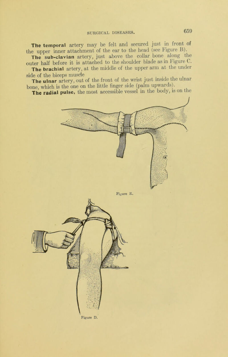 The temporal artery may be felt and secured just in front of the upper inner attachment of the ear to the head (see Figure B). The sub-clavian artery, just above the collar bone along the outer half before it is attached to the shoulder blade as in Figure C. The brachial artery, at the middle of the upper arm at the under side of the biceps muscle . . , The ulnar artery, out of the front of the wrist just inside the ulnar bone, which is the one on the little finger side (palm upwards). The radial pulse, the most accessible vessel in the body, is on the