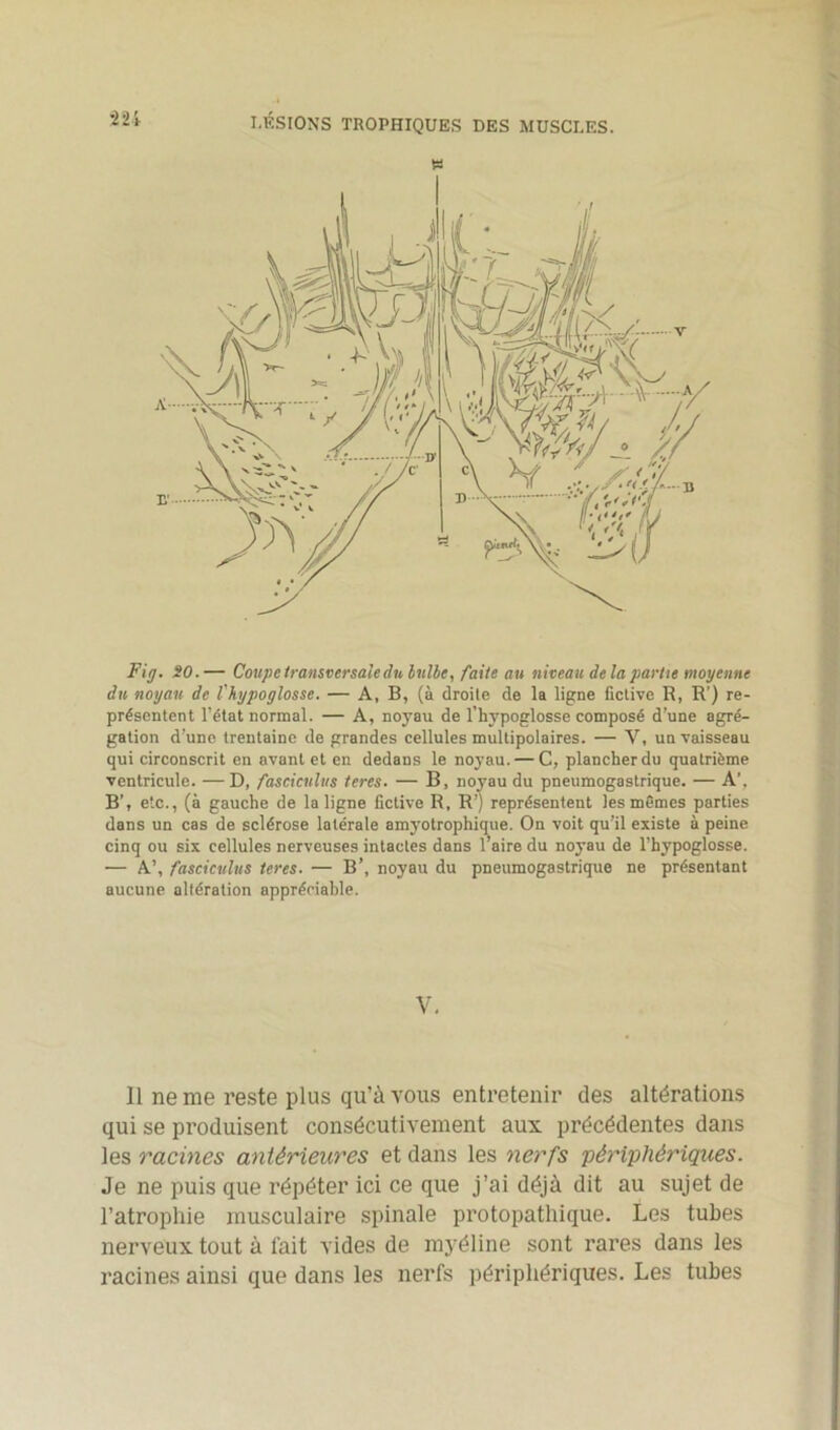 £ Fig. SO.— Coupc transversale du bulbe, faite au niveau delà partie moyenne du noyau de l'hypoglosse. — A, B, (à droite de la ligne fictive R, R') re- présentent l’état normal. — A, noyau de l’hypoglosse composé d’une agré- gation d'une trentaine de grandes cellules multipolaires. — Y, un vaisseau qui circonscrit en avant et en dedans le noyau. — C, plancher du quatrième ventricule. —D, fasciculus teres. — B, noyau du pneumogastrique. — A’, B’, etc., (à gauche de la ligne fictive R, R’) représentent les mêmes parties dans un cas de sclérose latérale amyotrophique. On voit qu'il existe à peine cinq ou six cellules nerveuses intactes dans l’aire du noyau de l’hypoglosse. — A’, fasciculus teres. — B’, noyau du pneumogastrique ne présentant aucune altération appréciable. V. Il ne me reste plus qu’à vous entretenir des altérations qui se produisent consécutivement aux précédentes dans les racines antérieures et dans les nerfs périphériques. Je ne puis que répéter ici ce que j’ai déjà dit au sujet de l’atrophie musculaire spinale protopathique. Les tubes nerveux tout à l’ait vides de myéline sont rares dans les racines ainsi que dans les nerfs périphériques. Les tubes