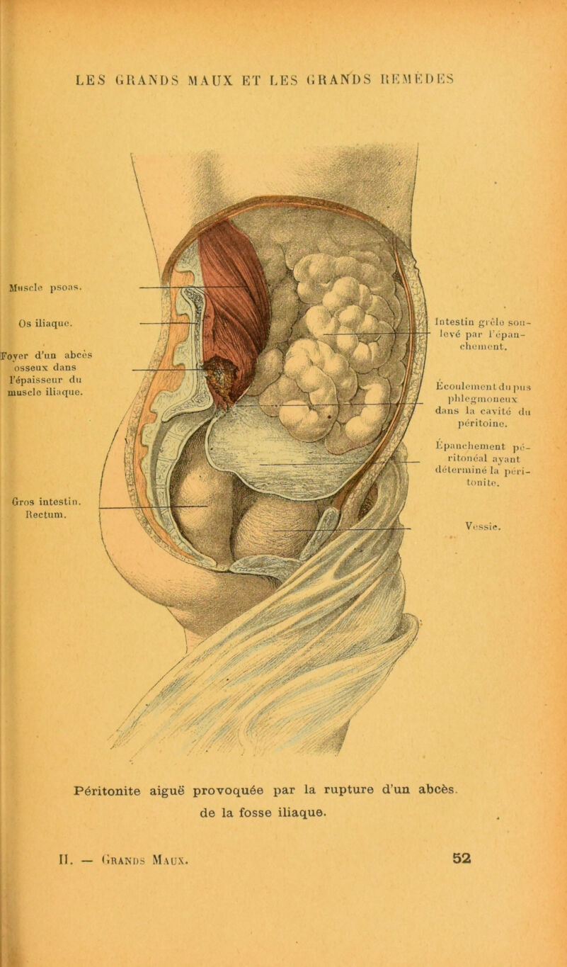 Muscle psoas. Os iliaque. Foyer d’un abcès osseux dans l’épaisseur du muscle iliaque. Gros intestin. Rectum. Intestin grêle sou- levé par l'épan- chement. Ecoulemcntdu pus phlegmonenx dans la cavité du péritoine. Epanchement pé- ritonéal ayant déterminé la péri- tonite. Vessie. Péritonite aiguë provoquée par la rupture d’un abcès. de la fosse iliaque.