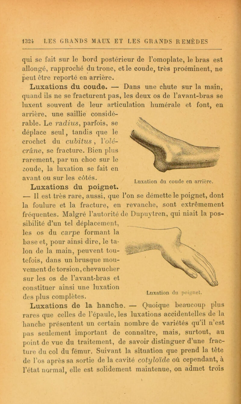 V qui se fait sur le bord postérieur de l’omoplate, le bras est allongé, rapproché du tronc, et le coude, très proéminent, ne peut être reporté en arrière. Luxations du coude. — Dans une chute sur la main, quand ils ne se fracturent pas, les deux os de l’avant-bras se luxent souvent de leur articulation humérale et font, en arrière, une saillie considé- rable. Le radius, parfois, se déplace seul, tandis que le crochet du cubitus, Volé- crâne, se fracture. Bien plus rarement, par un choc sur le coude, la luxation se fait en avant ou sur les côtés. Luxations du poignet. — Il est très rare, aussi, que l’on se démette le poignet, dont Luxation du coude en arrière. la foulure et la fracture, en revanche, sont extrêmement fréquentes. Malgré l’autorité de Dupindren, qui niait la pos- sibilité d’un tel déplacement, les os du carpe formant la base et, pour ainsi dire, le ta- lon de la main, peuvent tou- tefois, dans un brusque mou- vement de torsion, chevaucher sur les os de l’avant-bras et constituer ainsi une luxation , , Luxation du poianct. des plus complétés. Luxations de la hanche. — Quoique beaucoup plus rares que celles de l’épaule, les luxations accidentelles de la hanche présentent un certain nombre de variétés qu’il n’est j)as seulement important de connaître, mais, surtout, au point de vue du traitement, de savoir distinguer d’une frac- ture du col du fémur. Suivant la situation que prend la tête de l’os après sa sortie de la cavité cotyloïde où cependant, à l’état normal, elle est solidement maintenue, on admet trois