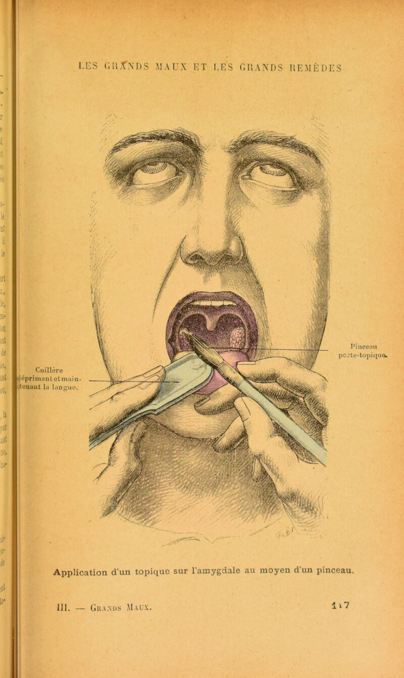 \ i Pinceau po.'lc-topiciucw I I fl Application d'un topique sur l'amygdale au moyen d'un pinceau. III. — li7 Gra.M).s M.vl'x