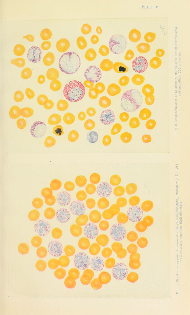 0 ;'V .lEQS oo § # lo o Film of Blood showing oreat increase of white cells (leucocytosis), stained with Ehrlich’s Film of Blood from case of Leukaemia, stained with Ehrlich’s triple stain triple stain and magnified 1000 diameters and magnified 1000 diameters