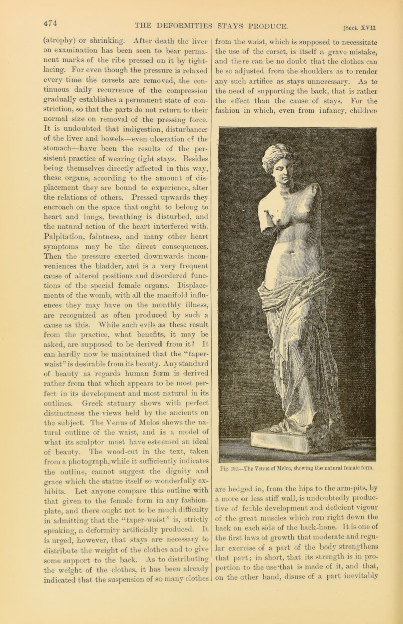 THE DEFORMITIES STAYS PRODUCE. [Sect. XVII (atrophy) or shrinking. After death the liver on examination has been seen to bear perma- nent marks of the ribs pressed on it by tight- lacing. For even though the pressure is relaxed every time the corsets are removed, the con- tinuous daily recurrence of the compression gradually establishes a permanent state of con- striction, so that the pai’ts do not return to their normal size on removal of the pressing force. It is undoubted that indigestion, disturbances of the liver and bowels—even ulceration of the stomach—have been the results of the per- sistent practice of wearing tight stays. Besides being themselves directly affected in this way, these organs, according to the amount of dis- placement they are bound to experience, alter the relations of others. Pressed upwards they encroach on the space that ought to belong to heart and lungs, breathing is disturbed, and the natural action of the heart interfered with. Palpitation, faintness, and many other heart symptoms may be the direct consequences. Then the pressure exerted downwards incon- veniences the bladder, and is a very frequent cause of altered positions and disordered func- tions of the special female organs. Displace- ments of the womb, with all the manifold influ- ences they may have on the monthly illness, are recognized as often ju'oduced by such a cause as this. While such evils as these result from the practice, what benefits, it may be asked, are supposed to be derived from it? It can hardly now be maintained that the “taper- waist” is desirable from its beauty. Any standard of beauty as regards human form is derived rather from that which appears to be most per- fect in its development and most natural in its outlines. Greek statuary shows with ])erfect distinctness the views held by the ancients on the subject. The Venus of Melos shows the na- tural outline of the waist, and is a model of what its sculptor must have esteemed an ideal of beauty. The wood-cut in the text, taken from a ])hotograph, while it sufficiently indicates the outline, cannot suggest the dignity and grace which the statue itself so wonderfully ex- hibits. Let anyone compare this outline with that given to the female form in any fashion- plate, and there ought not to be much difficulty in admitting that the “taper-waist” is, .strictly speaking, a deformity artificially produced. It is urged, however, that stays are necessary to distribute the weight of the clothes and to give some support to the back. As to distributing the weight of the clothes, it has been ali’eady indicated that the suspension of so many clothes from the waist, which is supposed to nece.ssitate the use of the corset, is itself a grave mistake, and there can be no doubt that the clothes can be so adjusted from the shoulders as to render any such artifice as stays unnecessary. As to the need of supportiiig the back, that is i-ather the effect than the cause of stays. For the fashion in which, even from infanc}', children Fig. 182.—The Venus of Melos, showing the natural female form. are hedgeil in, from the hips to the arm-jnts, by a more or less stiff wall, is undoubtedly produc- tive of feeble development and deficient vigour of the great muscles which run right down the back on each side of the back-bone. It is one of the first laws of growth that moderate and regu- lar exercise of a part of the body strengthens that part; in short, that its strength is in ]>ro- portion to the use'that is made of it, and that, on the other liand, disuse of a jiart inevitably