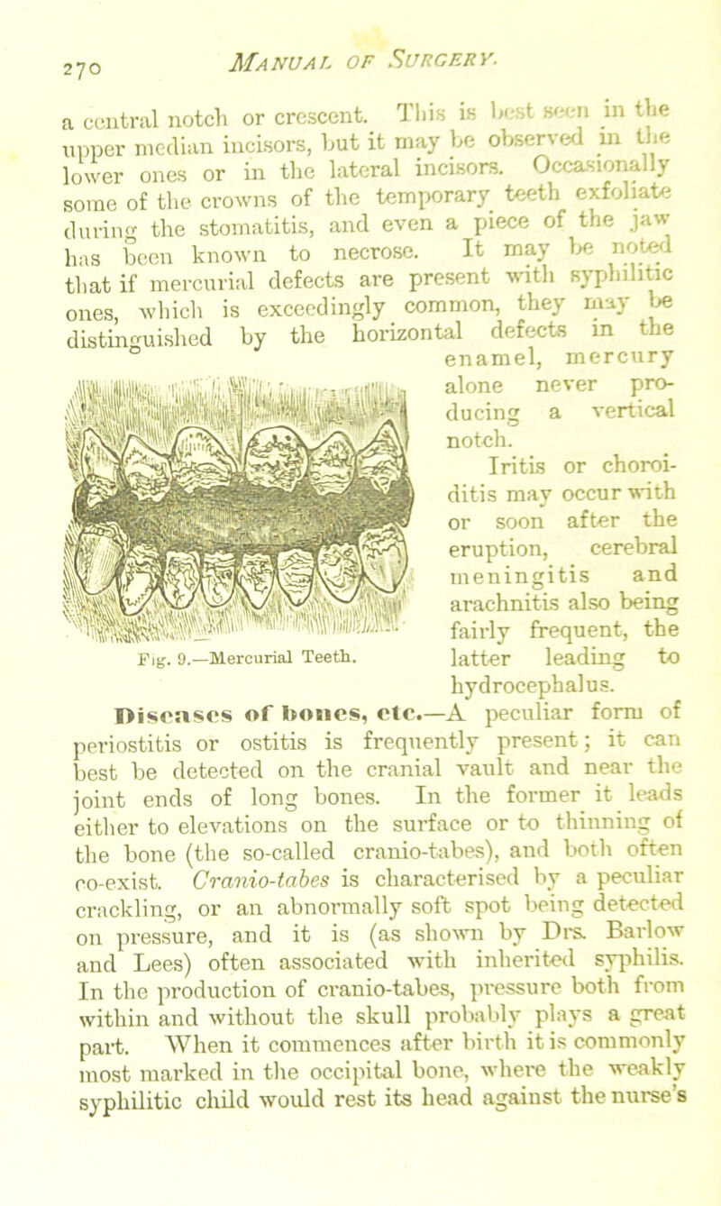 a central notch or crescent. This in tx ' Be m m the upper median incisors, hut it may be observed m the lower ones or in the lateral incisors. Occasionally some of the crowns of the temporary teeth exfoliate durin the stomatitis, and even a piece of the jaw has been known to necrose. It may be noted that if mercurial defects are present with syphilitic ones, which is exceedingly common, they may be distinguished by the horizontal defects in the enamel, mercury alone never pro- ducing a vertical notch. Iritis or choroi- ditis may occur with or soon after the eruption, cerebral meningitis and arachnitis also being fairly frequent, the Fig. 9.—Mercurial Teeth. latter leading to hydrocephalus. Diseases of bones, etc.—A peculiar form of periostitis or ostitis is frequently present; it can best be detected on the cranial vault and near the joint ends of long bones. In the former it leads either to elevations on the surface or to thinning of the bone (the so-called cranio-tabes), and both often co-exist. Cranio-tabes is characterised by a peculiar crackling, or an abnormally soft spot being detected on pressure, and it is (as shown by Drs. Barlow and Lees) often associated with inherited syphilis. In the production of cranio-tabes, pressure both from within and without the skull probably plays a great part. When it commences after birth it is commonly most marked in the occipital bone, where the weakly syphilitic child would rest its head against the nurse’s