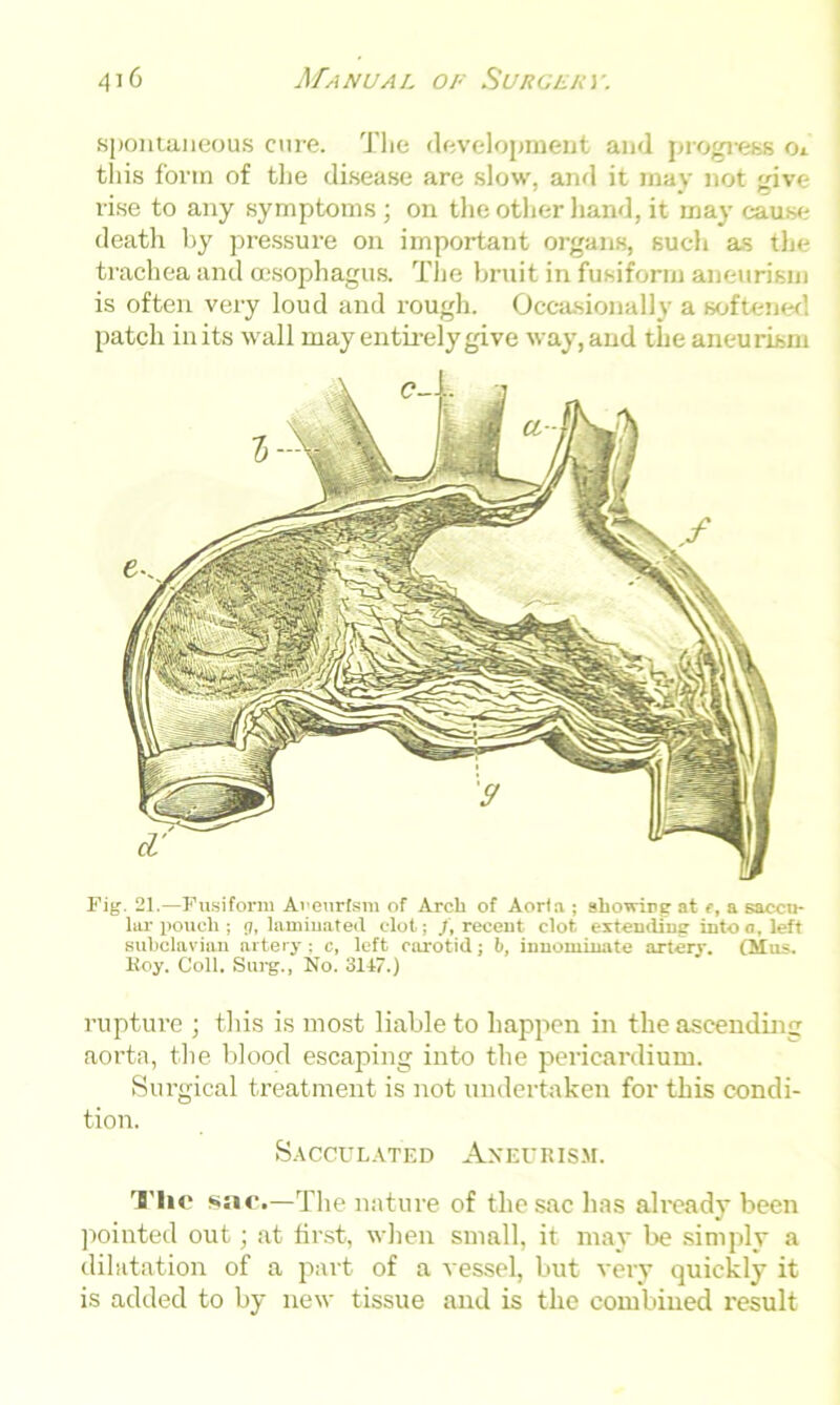 spontaneous cure. The development and progress o. this form of the disease are slow, and it may not give rise to any symptoms ; on the other hand, it may cause death by pressure on important organs, such as the trachea and oesophagus. The bruit in fusiform aneurism is often very loud and rough. Occasionally a softened patch inits wall may entirely give way, and the aneurism Fig. 21.—Fusiform Aneurism of Arch of Aorta ; showing at f, a saccu- lar pouch; g, laminated clot; /, recent clot extending into a, left subclavian artery: c, left carotid; b, innominate artery. (Mus. Roy. Coll. Surg., No. 3147.) rupture ; this is most liable to happen in the ascending aorta, the blood escaping into the pericardium. Surgical treatment is not undertaken for this condi- tion. Sacculated Aneurism. The sac.—The nature of the sac has already been pointed out; at first, when small, it may be simply a dilatation of a part of a vessel, but very quickly it is added to by new tissue and is the combined result