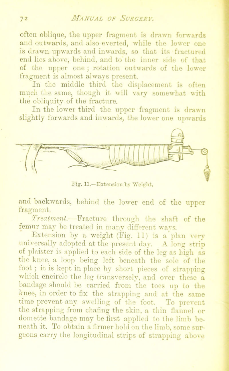 often oblique, the upper fragment is drawn forwards and outwards, and also everted, while the lower one is drawn upwards and inwards, so that its fractured end lies above, behind, and to the inner side of that of the upper one; rotation outwards of the lower fragment is almost always present. In the middle third the displacement is often much the same, though it will vary somewhat with the obliquity of the fracture. In the lower third the upper fragment is drawn slightly forwards and inwards, the lower one upwards and backwards, behind the lower end of the upper fragment. Treatment.—Fracture through the shaft of the femur may be treated in many different wavs. Extension by a weight (Fig. 11) is a plan very universally adopted at the present day. A long strip of plaister is applied to each side of the leg as high as the knee, a loop being left beneath the sole of the foot; it is kept in place by short pieces of strapping which encircle the leg transversely, and over these a bandage should be carried from the toes up to the knee, in order to fix the strapping and at the same time prevent any swelling of the foot. To prevent the strapping from chafing the skin, a thin flannel or domette bandage may be first applied to the limb be- neath it. To obtain a firmer hold on the limb, some sur- geons carry the longitudinal strips of strapping above