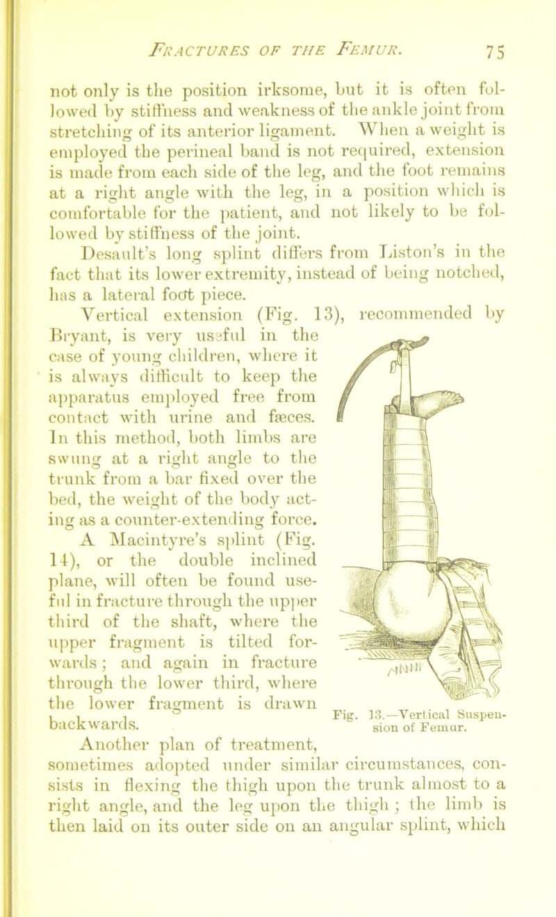 not only is the position ii’ksome, but it is often fol- lowed by stiffness and weakness of the ankle joint from stretching of its anterior ligament. When a weight is employed the perineal band is not required, extension is made from each side of the leg, and the foot remains at a right angle with the leg, in a position which is comfortable for the patient, and not likely to be fol- lowed by stiffness of the joint. Desault’s long splint differs from Liston’s in the fact that its lower extremity, instead of being notched, has a lateral focft piece. Vertical extension (Fig. 13), recommended by Bryant, is very useful in the case of young children, where it is always difficult to keep the apparatus employed free from contact with urine and faeces. In this method, both limbs are swung at a right angle to the trunk from a bar fixed over the bed, the weight of the body act- ing as a counter-extending force. A Macintyre’s splint (Fig. 14), or the double inclined plane, will often be found use- ful in fracture through the upper third of the shaft, where the upper fragment is tilted for- wards ; and again in fracture thi'ough the lower third, where the lower fragment is drawn backwards. Another plan of treatment, sometimes adopted under similar circumstances, con- sists in flexing the thigh upon the trunk almost to a right angle, and the leg upon the thigh; the limb is then laid on its outer side on an angular splint, which 13.—Vertical Suspen- sion of Femur.