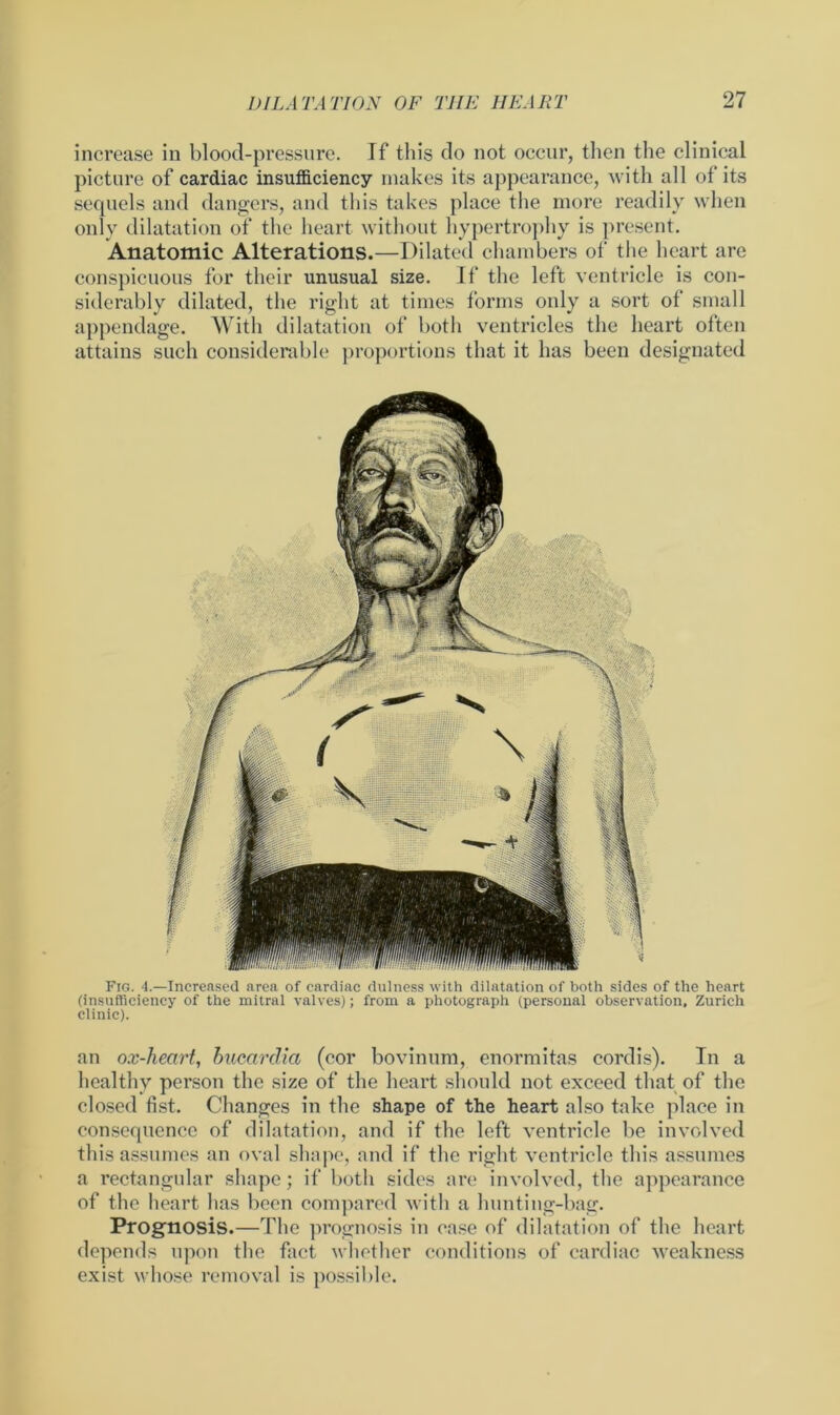 increase in blood-pressure. If this do not occur, then the clinical picture of cardiac insufficiency makes its appearance, with all of its sequels and dangers, and this takes place the more readily when only dilatation of the heart without hypertrophy is present. Anatomic Alterations.—Dilated chambers of the heart are conspicuous for their unusual size. If the left ventricle is con- siderably dilated, the right at times forms only a sort of small appendage. With dilatation of both ventricles the heart often attains such considerable proportions that it has been designated Fig. 4.—Increased area of cardiac dulness with dilatation of both sides of the heart (insufficiency of the mitral valves); from a photograph (personal observation, Zurich clinic). an ox-heart, bucardia (cor bovinum, enormitas cordis). In a healthy person the size of the heart should not exceed that of the closed fist. Changes in the shape of the heart also take place in consequence of dilatation, and if the left ventricle be involved this assumes an oval shape, and if the right ventricle this assumes a rectangular shape; if both sides are involved, the appearance of the heart has been compared with a hunting-bag. Prognosis.—The prognosis in case of dilatation of the heart depends upon the fact whether conditions of cardiac weakness exist whose removal is possible.