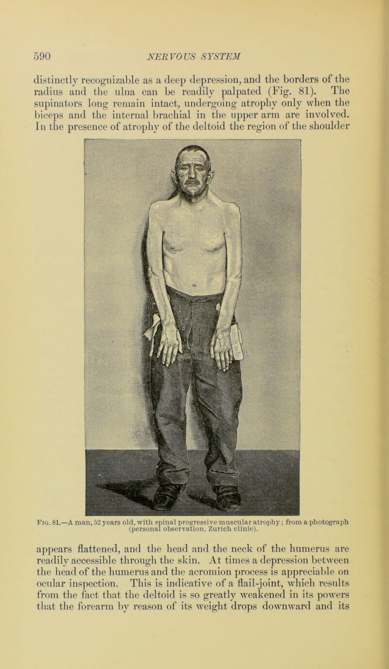 distinctly recognizable as a deep depression, and the borders of the radius and the ulna can be readily palpated (Fig. 81). The supinators long remain intact, undergoing atrophy only when the biceps and the internal brachial in the upper arm are involved. In the presence of atrophy of the deltoid the region of the shoulder Fig. 81.—A man, 52 years old, with spinal progressive muscular atrophy; from a photograph (personal observation, Zurich clinic). appears flattened, and the head and the neck of the humerus are readily accessible through the skin. At times a depression between the head of the humerus and the acromion process is appreciable on ocular inspection. This is indicative of a flail-joint, which results from the fact that the deltoid is so greatly weakened in its powers that the forearm by reason of its weight drops downward and its