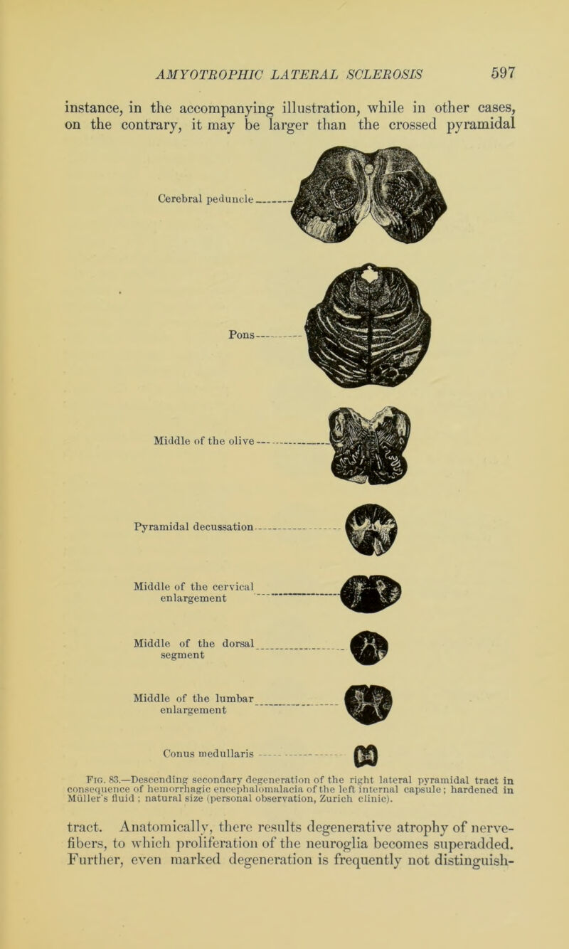 instance, in the accompanying illustration, while in other cases, on the contrary, it may be larger than the crossed pyramidal Cerebral peduncle Pyramidal decussation Middle of tlie cervical enlargement Middle of the dorsal segment Middle of the lumbar enlargement Conus medullaris Fig. 83.—Descending secondary degeneration of the right lateral pyramidal tract in consequence of hemorrhagic encephalomalacia of the left internal capsule; hardened in Müllers fluid ; natural size (personal observation, Zurich clinic). tract. Anatomically, there results degenerative atrophy of nerve- fibers, to which proliferation of the neuroglia becomes superadded. Further, even marked degeneration is frequently not distinguish-