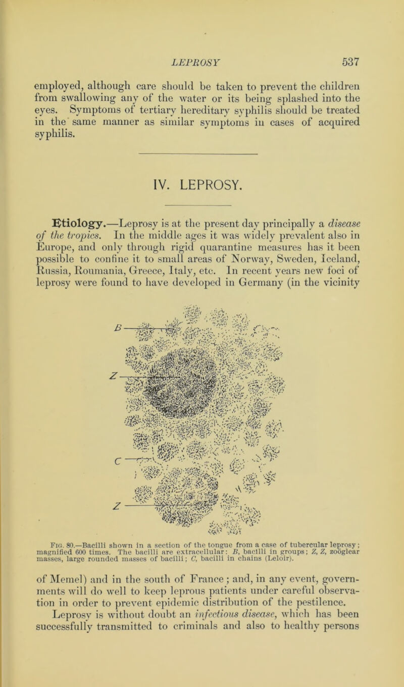 employed, although care should be taken to prevent the children from swallowing any of the water or its being splashed into the eyes. Symptoms of tertiary hereditary syphilis should be treated in the same manner as similar symptoms in cases of acquired syphilis. IV. LEPROSY. Etiology.—Leprosy is at the present day principally a disease of the tropics. In the middle ages it was widely prevalent also in Europe, and only through rigid quarantine measures has it been possible to confine it to small areas of Norway, Sweden, Iceland, Russia, Roumania, Greece, Italy, etc. In recent years new foci of leprosy were found to have developed in Germany (in the vicinity Fig. 80.—Bacilli shown in a section of the tongue from a case of tubercular leprosy; magnified 600 times. The bacilli are extracellular: B, bacilli in groups; Z, Z, zoöglear masses, large rounded masses of bacilli; C, bacilli in chains (Leloir). of Memel) and in the south of France ; and, in any event, govern- ments will do well to keep leprous patients under careful observa- tion in order to prevent epidemic distribution of the pestilence. Leprosv is without doubt an infectious disease, which has been successfully transmitted to criminals and also to healthy persons