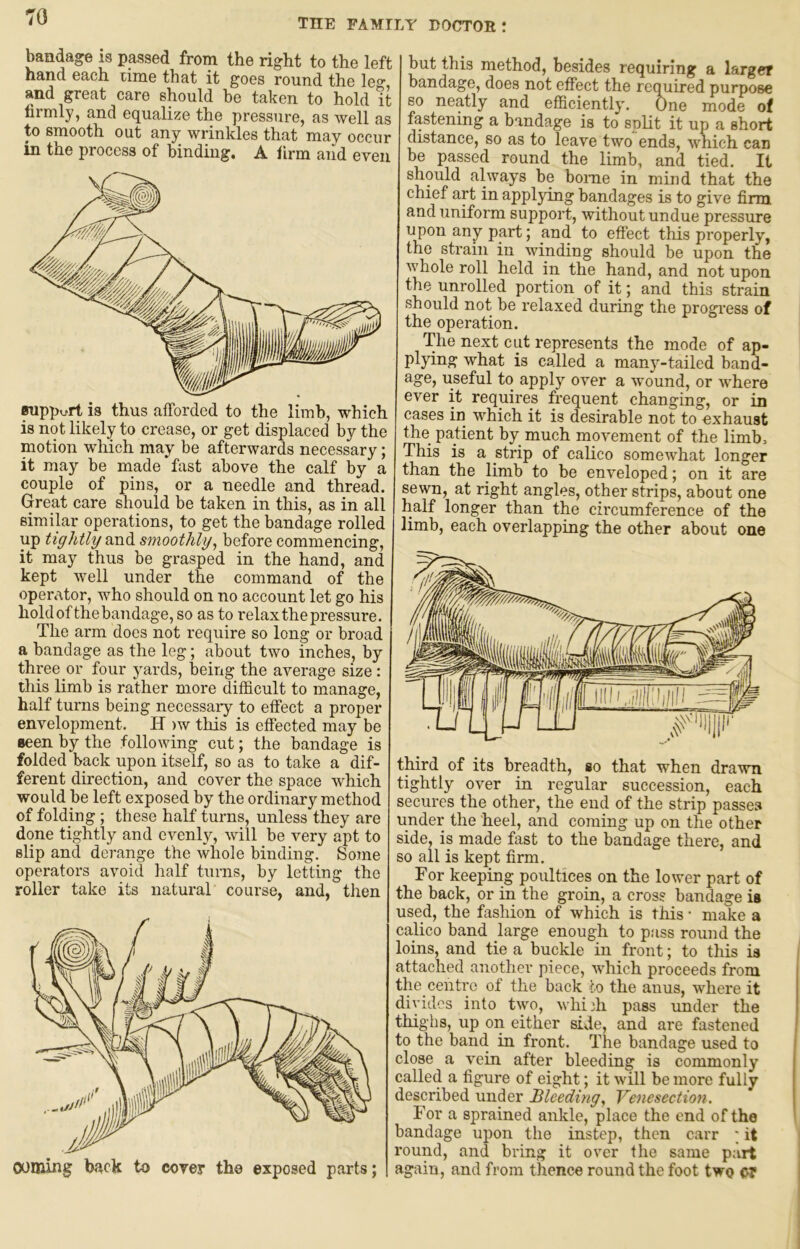 the family doctor: bandage is passed from the right to the left hand each time that it goes round the leo- and great care should be taken to hold it firmly, and equalize the pressure, as well as to smooth out any wrinkles that may occur in the process of binding. A firm and even TOppc-rt is thus afforded to the limb, which is not likely to crease, or get displaced by the motion which may be afterwards necessary; it may be made fast above the calf by a couple of pins, or a needle and thread. Great care should be taken in this, as in all similar operations, to get the bandage rolled up tightly smoothly^ before commencing, it may thus be grasped in the hand, and kept well under the command of the operator, who should on no account let go his hold of the bandage, so as to relax the pressure. The arm does not require so long or broad a bandage as the leg; about two inches, by three or four yards, being the average size : this limb is rather more difficult to manage, half turns being necessary to effect a proper envelopment. H )w this is effected may be Been by the following cut; the bandage is folded back upon itself, so as to take a dif- ferent direction, and cover the space which would be left exposed by the ordinary method of folding ; these half turns, unless they are done tightly and evenly, will be very apt to slip and derange the whole binding. Some operators avoid half turns, by letting the roller take its natural course, and, then coming back to cover the exposed parts; but this method, besides requiring a larger bandage, does not effect the required purpose so neatly and efficiently'. One mode of fastening a bandage is to split it up a short distance, so as to leave two ends, which can be passed round the limb, and tied. It should always be borne in mind that the chief art in applying bandages is to give firm and uniform support, without undue pressure upon any part; and to effect this properly, the strain in winding should be upon the whole roll held in the hand, and not upon the unrolled portion of it; and this strain should not be relaxed during the progress of the operation. The next cut represents the mode of ap- plying what is called a many^-tailed band- age, useful to apply over a wound, or where ever it requires frequent changing, or in cases in which it is desirable not to exhaust the patient by much movement of the limb. This is a strip of calico somewhat longer than the limb to be enveloped; on it are sewn, at right angles, other strips, about one half longer than the circumference of the limb, each overlapping the other about one third of its breadth, so that when drawn tightly over in regular succession, each secures the other, the end of the strip passes under the heel, and coming up on the other side, is made fast to the bandage there, and so all is kept firm. For keeping poultices on the lower part of the back, or in the groin, a cross bandage is used, the fashion of which is this * make a calico band large enough to pass round the loins, and tie a buckle in front; to this is attached another piece, which proceeds from the centre of the back to the anus, where it divides into two, whiih pass under the thighs, up on either side, and are fastened to the band in front. The bandage used to close a vein after bleeding is commonly called a figure of eight; it will be more fully described under Bleeding^ Venesection. For a sprained ankle, place the end of the bandage upon the instep, then carr ; it round, and bring it over the same part again, and from thence round the foot two 0?