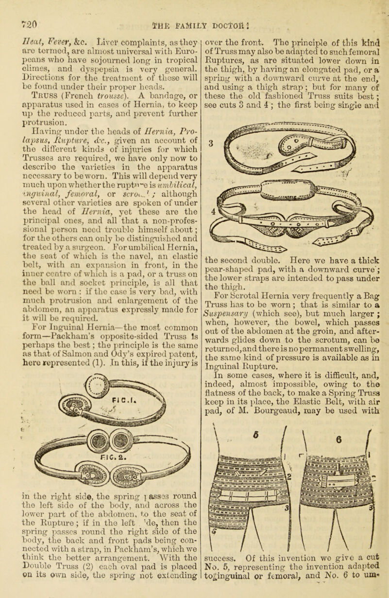 Ileai, Fever, kc. Llvcl‘ complaints, as they are termed, are almost xiniversal with Euro- peans who have sojourned long in tropical climes, and dyspe{)sia is very general. Directions for the treatment of these will be found under their proper heads. Truss (French trousse). A bandage, or apparatus used in cases of Hernia, to keep up the reduced parts, and prevent further protrusion. Having under the heads of Hernia, Pro- la'psus, lixiptnre, &c., given an account of the different kinds of injuries for M^hich Trusses are required, we have only now to describe the varieties in the apparatus necessary to be worn. This will depend very much upon whether the rupture is umhilical, ‘.nguinal, femoral, or scroiH ; aithongh several other varieties are spoken of under the head of Hernia, yet these ai’e the principal ones, and all that a non-profes- sional person need trouble himself about; for the others can only bo distinguished and treated by a surgeon. For umbilical Hernia, the seat of which is the navel, an elastic bolt, with an expansion in front, in the inner centre of which is a pad, or a truss on the ball and socket principle, is all that need be worn : if the case is very bad, with much protrusion and enlargement of the abdomen, an aj^paratus expressly made for it will be required. For Inguinal Hernia—the most common form—Packham’s opposite-sided Truss Is perhaps the best; the principle is the same as that of Salmon and Ody’s exi:>ired patent, here represented (1). In this, if the injury is in the right side, the spring | asses round the left side of the body, and across the lower part of the abdomen, to the seat of the Rupture ; if in the left 'de, then the spring passes round the right side of the body, the back and front pads being con- nected with a strap, in Packham’s, which we think the better arrangement. With the Double Truss (2) each oval pad is placed on its own side, the spring not exl.cnding over the front. The principle of this kind of Truss may also be adapted to such femoral Ruptures, as are situated lower down in the thigh, by haring an elongated pad, or a spring with a downward curve at the end, and using a thigh strap; but for many of these the old fashioned Truss suits best; see cuts 3 and 4 ; the first being single and the second double. Here we have a thick pear-shaped pad, with a downward curve'; the lower straps are intended to pass under the thigh. For Scrotal Hernia very frequently a Bag Truss has to be worn ; that is similar to a Suspensarg (which see), but much larger ; when, however, the bowel, which passes out of the abdomen at the groin, and after- wards glides down to the scrotum, can bo returned, and there is no permanent swelling, the same kind of pressure is available as in Inguinal Rupture. In some cases, where it is difficult, and, indeed, almost impossible, owing to the flatness of the back, to make a Spring Truss keep in its place, the Elastic Belt, with air pad, of M. Bourgeaud, may be used with success. Of this invention wo give a cut No. 5, representing the invention adapted toj^inguiual or femoral, and No. 6 to urn*