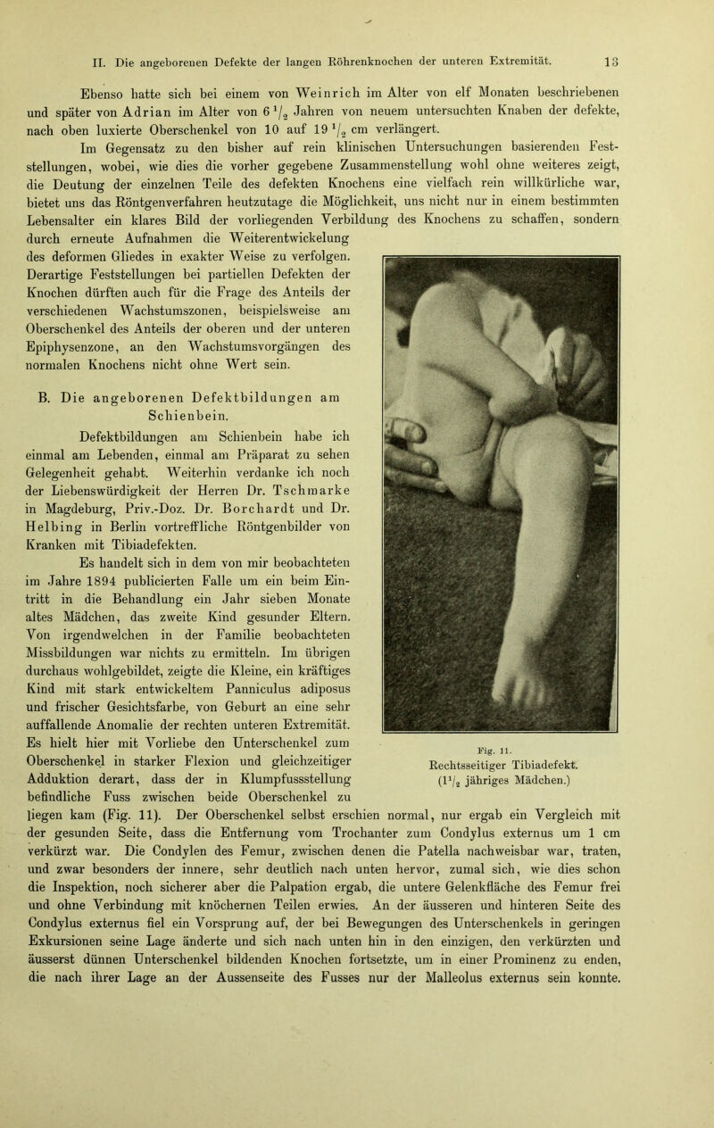 Ebenso hatte sich bei einem von Weinrich im Alter von elf Monaten beschriebenen und später von Adrian im Alter von 6 x/2 Jahren von neuem untersuchten Knaben der defekte, nach oben luxierte Oberschenkel von 10 auf 19 x/a cm verlängert. Im Gegensatz zu den bisher auf rein klinischen Untersuchungen basierenden Fest- stellungen, wobei, wie dies die vorher gegebene Zusammenstellung wohl ohne weiteres zeigt, die Deutung der einzelnen Teile des defekten Knochens eine vielfach rein willkürliche war, bietet uns das Röntgenverfahren heutzutage die Möglichkeit, uns nicht nur in einem bestimmten Lebensalter ein klares Bild der vorliegenden Verbildung des Knochens zu schaffen, sondern durch erneute Aufnahmen die Weiterentwickelung des deformen Gliedes in exakter Weise zu verfolgen. Derartige Feststellungen bei partiellen Defekten der Knochen dürften auch für die Frage des Anteils der verschiedenen Wachstumszonen, beispielsweise am Oberschenkel des Anteils der oberen und der unteren Epiphysenzone, an den Wachstumsvorgängen des normalen Knochens nicht ohne Wert sein. B. Die angeborenen Defektbildungen am Schienbein. Defektbildungen am Schienbein habe ich einmal am Lebenden, einmal am Präparat zu sehen Gelegenheit gehabt. Weiterhin verdanke ich noch der Liebenswürdigkeit der Herren Dr. Tschmarke in Magdeburg, Priv.-Doz. Dr. Borchardt und Dr. Helbing in Berlin vortreffliche Röntgenbilder von Kranken mit Tibiadefekten. Es handelt sich in dem von mir beobachteten im Jahre 1894 publicierten Falle um ein beim Ein- tritt in die Behandlung ein Jahr sieben Monate altes Mädchen, das zweite Kind gesunder Eltern. Von irgendwelchen in der Familie beobachteten Missbildungen war nichts zu ermitteln. Im übrigen durchaus wohlgebildet, zeigte die Kleine, ein kräftiges Kind mit stark entwickeltem Panniculus adiposus und frischer Gesichtsfarbe, von Geburt an eine sehr auffallende Anomalie der rechten unteren Extremität. Es hielt hier mit Vorliebe den Unterschenkel zum Oberschenkel in starker Flexion und gleichzeitiger Adduktion derart, dass der in Klumpfussstellung befindliche Fuss zwischen beide Oberschenkel zu liegen kam (Fig. 11). Der Oberschenkel selbst erschien normal, nur ergab ein Vergleich mit der gesunden Seite, dass die Entfernung vom Trochanter zum Condylus externus um 1 cm verkürzt war. Die Condylen des Femur, zwischen denen die Patella nachweisbar -war, traten, und zwar besonders der innere, sehr deutlich nach unten hervor, zumal sich, wie dies schon die Inspektion, noch sicherer aber die Palpation ergab, die untere Gelenkfläche des Femur frei und ohne Verbindung mit knöchernen Teilen erwies. An der äusseren und hinteren Seite des Condylus externus fiel ein Vorsprung auf, der bei Bewegungen des Unterschenkels in geringen Exkursionen seine Lage änderte und sich nach unten hin in den einzigen, den verkürzten und äusserst dünnen Unterschenkel bildenden Knochen fortsetzte, um in einer Prominenz zu enden, die nach ihrer Lage an der Aussenseite des Fusses nur der Malleolus externus sein konnte. Fig. 11. Rechtsseitiger Tibiadefekt. (I1/, jähriges Mädchen.)