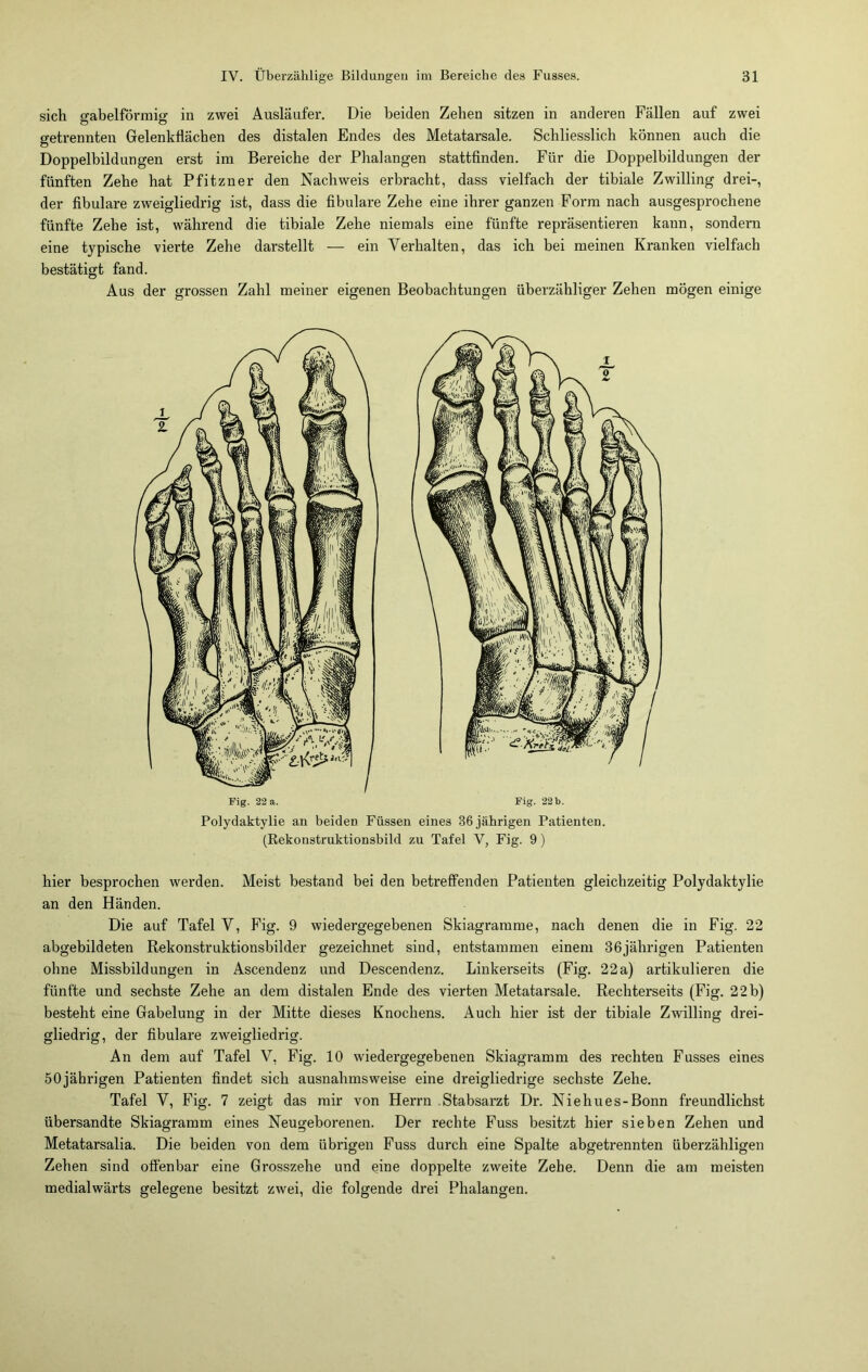 sich gabelförmig in zwei Ausläufer. Die beiden Zehen sitzen in anderen Fällen auf zwei getrennten Gelenkflächen des distalen Endes des Metatarsale. Schliesslich können auch die Doppelbildungen erst im Bereiche der Phalangen stattfinden. Für die Doppelbildungen der fünften Zehe hat Pfitzner den Nachweis erbracht, dass vielfach der tibiale Zwilling drei-, der fibulare zweigliedrig ist, dass die fibulare Zehe eine ihrer ganzen Form nach ausgesprochene fünfte Zehe ist, während die tibiale Zehe niemals eine fünfte repräsentieren kann, sondern eine typische vierte Zehe darstellt — ein Verhalten, das ich bei meinen Kranken vielfach bestätigt fand. Aus der grossen Zahl meiner eigenen Beobachtungen überzähliger Zehen mögen einige Fig. 22 a. Fig. 22 b. Polydaktylie an beideD Füssen eines 36 jährigen Patienten. (Rekonstruktionsbild zu Tafel V, Fig. 9) hier besprochen werden. Meist bestand bei den betreffenden Patienten gleichzeitig Polydaktylie an den Händen. Die auf Tafel V, Fig. 9 wiedergegebenen Skiagramme, nach denen die in Fig. 22 abgebildeten Rekonstruktionsbilder gezeichnet sind, entstammen einem 36jährigen Patienten ohne Missbildungen in Ascendenz und Descendenz. Linkerseits (Fig. 22a) artikulieren die fünfte und sechste Zehe an dem distalen Ende des vierten Metatarsale. Rechterseits (Fig. 22 b) besteht eine Gabelung in der Mitte dieses Knochens. Auch hier ist der tibiale Zwilling drei- gliedrig, der fibulare zweigliedrig. An dem auf Tafel V, Fig. 10 wiedergegebenen Skiagramm des rechten Fusses eines 50jährigen Patienten findet sich ausnahmsweise eine dreigliedrige sechste Zehe. Tafel V, Fig. 7 zeigt das mir von Herrn Stabsarzt Dr. Niehues-Bonn freundlichst übersandte Skiagramm eines Neugeborenen. Der rechte Fuss besitzt hier sieben Zehen und Metatarsalia. Die beiden von dem übrigen Fuss durch eine Spalte abgetrennten überzähligen Zehen sind offenbar eine Grosszehe und eine doppelte zweite Zehe. Denn die am meisten medialwärts gelegene besitzt zwei, die folgende drei Phalangen.