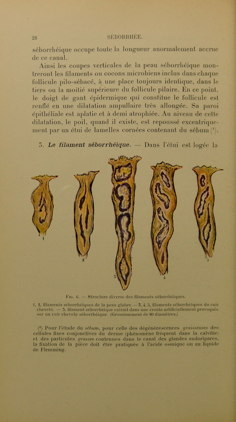 séborrhéique occupe loulc la longueur anormalement accrue tic cc canal. Ainsi les coupes verticales de la peau séborrhéique mon- treront les filaments ou cocons microbiens inclus dans chaque follicule pilo-sébacé, à une place toujours identique, dans le tiers ou la moitié supérieure du follicule pilaire. En ce point, le doigt de gant épidermique qui constitue le follicule est renflé en une dilatation ampullaire très allongée. Sa paroi épithéliale est aplatie et à demi atrophiée. Au niveau de cette dilatation, le poil, quand il existe, est repoussé excentrique- ment par un étui de lamelles cornées contenant du sébum (*). o. Le filament séborrhéique. — Dans l’étui est logée la Fig. 6. — Structure diverse des filaments séborrhéiques. 1, 2, filaments séborrhéiques de la peau glabre. — 3,4, 5, filaments séborrhéiques du cuir chevelu. — 5, filament séborrhéique extrait dans une croûte artificiellement provoquée sur un cuir chevelu séborrhéique. (Grossissement de 80 diamètres.) (*) Pour l’étude du sébum, pour celle des dégénérescences graisseuses des cellules Fixes conjonctives du derme (phénomène fréquent dans la calvitie) et des particules grasses contenues dans le canal des glandes sudoripares. la Fixation de la pièce doit être pratiquée à l’acide osmique ou au liquide de Flemrning.