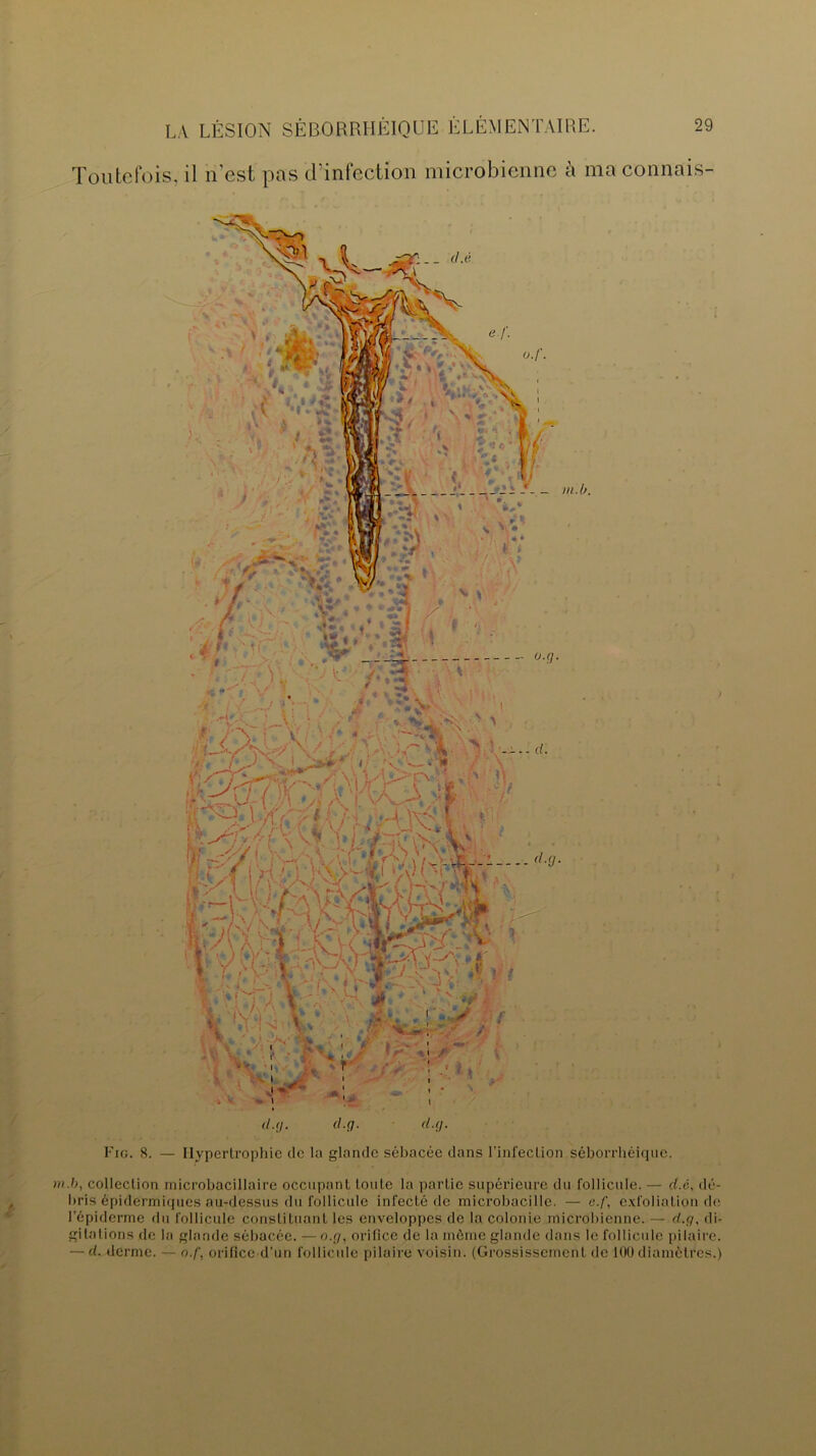 Toutefois, il n’est pas d’infection microbienne à maconnais- Fig. 8. — Hypertrophie de la glande sébacée dans l’infection séborrhéique. m.b, collection microbacillaire occupant toute la partie supérieure du follicule. — d.c, dé- bris épidermiques au-dessus du follicule infecté de microbacille. — e.f, exfoliation de l’épiderme du follicule constituant les enveloppes de la colonie microbienne. — d.g, di- gitations de la glande sébacée. — n.g, orifice de la môme glande dans le follicule pilaire. — d. derme. — n.f, orifice d’un follicule pilaire voisin. (Grossissement de 100diamètres.)