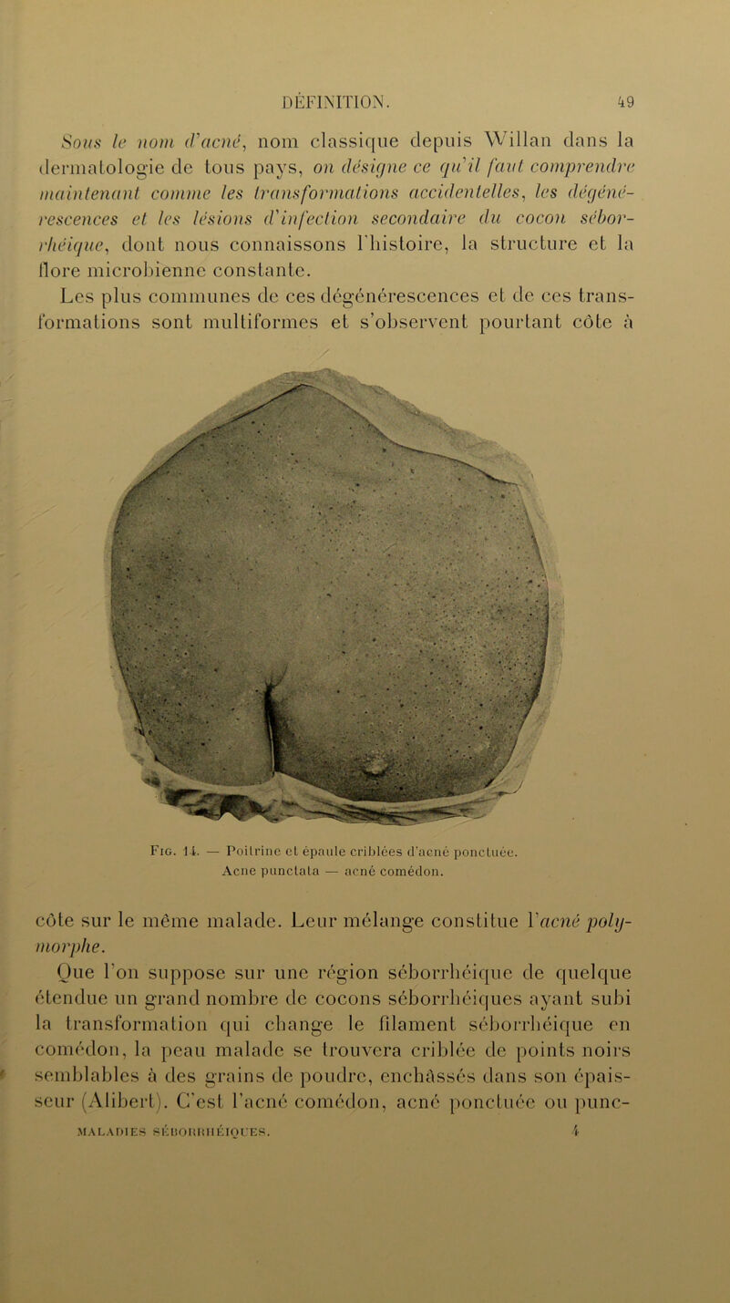 Sous le nom d'acné, nom classique depuis Willan dans la dermatologie de tous pays, on désigne ce qu'il faut comprendre maintenant comme les transformations accidentelles, les dégéné- rescences et les lésions d'infection secondaire du cocon sébor- rhéique, dont nous connaissons l'histoire, la structure et la llore microbienne constante. Les plus communes de ces dégénérescences et de ces trans- formations sont multiformes et s’observent pourtant côte à Fig. 14. — Poitrine et épaule criblées d’aené ponctuée. Acné punctata — acné comédon. côte sur le même malade. Leur mélange constitue Vacné poly- morphe. Que l'on suppose sur une région séborrhéique de quelque étendue un grand nombre de cocons séborrhéiques ayant subi la transformation qui change le filament séborrhéique en comédon, la peau malade se trouvera criblée de points noirs semblables à des grains de poudre, enchâssés dans son épais- seur (Alibert). C’est l’acné comédon, acné ponctuée ou punc- MALADIES SÉBORRHÉIQUES. 4