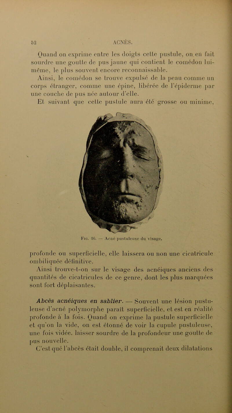 Quand on exprime entre les doigts cette pustule, on. en fait sourdre une goutte de pus jaune qui contient le comédon lui- même, le plus souvent encore reconnaissable. Ainsi, le comédon se trouve expulsé de la peau comme un corps étranger, comme une épine, libérée de l’épiderme par une couche de pus née autour d’elle. Et suivant que cette pustule aura été grosse ou minime, Fig. 16. — Acné pustuleuse du visage. profonde ou superficielle, elle laissera ou non une cicatricule ombiliquée définitive. Ainsi trouve-t-on sur le visage des acnéiques anciens des quantités de cicatricules de ce genre, dont les plus marquées sont fort déplaisantes. Abcès acnéiques en sablier. — Souvent une lésion pustu- leuse d’acné polymorphe paraît superficielle, et est en réalité profonde à la fois. Quand on exprime la pustule superficielle et qu’on la vide, on est étonné de voir la cupule pustuleuse, une fois vidée, laisser sourdre de la profondeur une goutte de pus nouvelle. C’est qué l’abcès était double, il comprenait deux dilatations