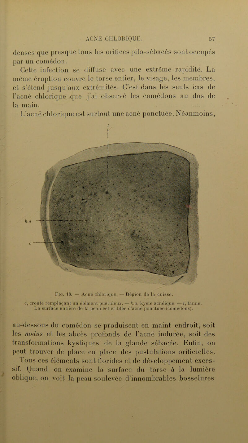 denses que presque tous les orificespilo-sébacés sontoccupés par un comédon. Cette infection se diffuse avec une extrême rapidité. La même éruption couvre le torse entier, le visage, les membres, et s’étend jusqu’aux extrémités. C’est dans les seuls cas de l’acné chloriquc que j'ai observé les comédons au dos de la main. L'acné chlorique est surtout une acné ponctuée. Néanmoins, t Fig. 18. — Acné chlorique. — Région de la cuisse. c, croûte remplaçant un élément pustuleux. — k.a, kyste acnéique. — t, tanne. La surface entière de la peau est criblée d’acné ponctuée (comédons). au-dessous du comédon se produisent en maint endroit, soit les nocliis et les abcès profonds de l’acné indurée, soit des transformations kystiques de la glande sébacée. Enfin, on peut trouver de place en place des pustulations orificielles. Tous ces éléments sont floridcs et de développement exces- sif. Quand on examine la surface du torse à la lumière oblique, on voit la peau soulevée d’innombrables bosselures